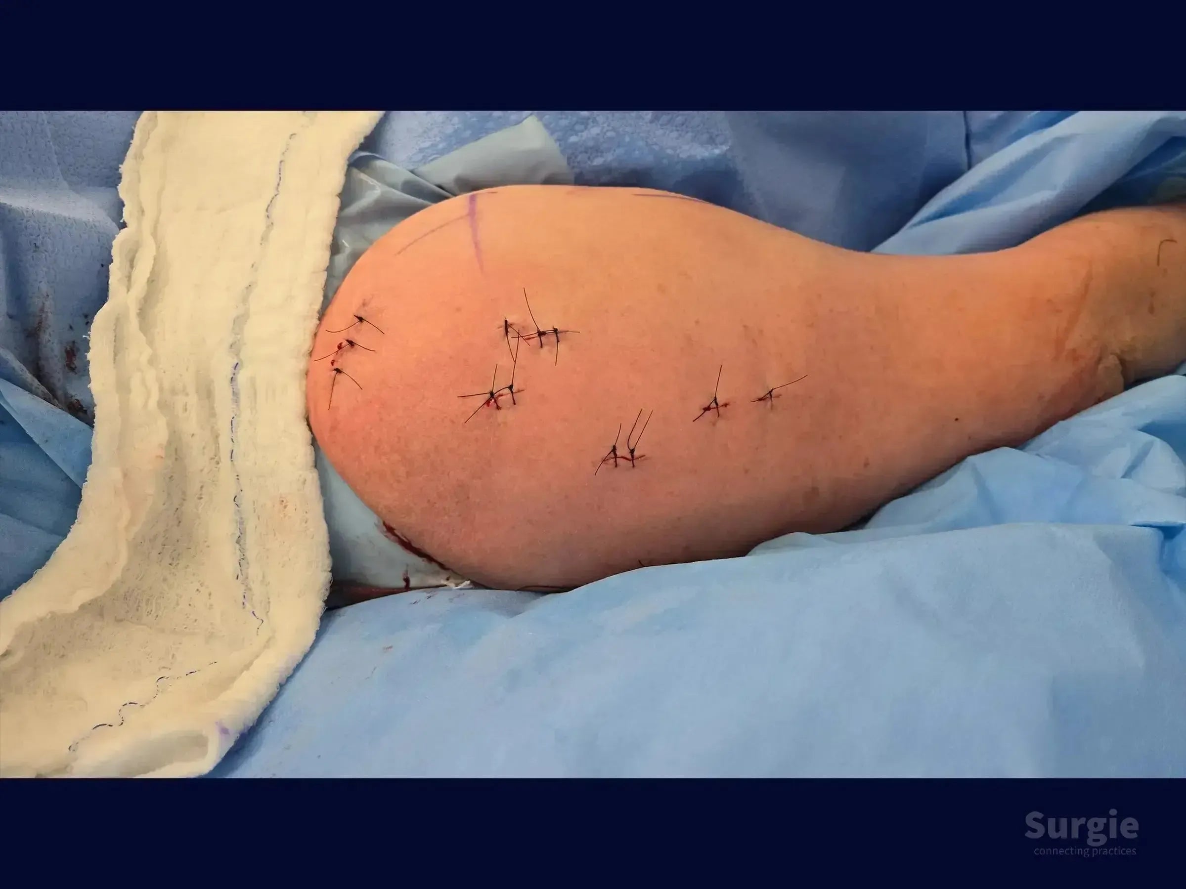 Shoulder skin with multiple small surgical incisions closed with black sutures after minimally invasive humerus surgery.