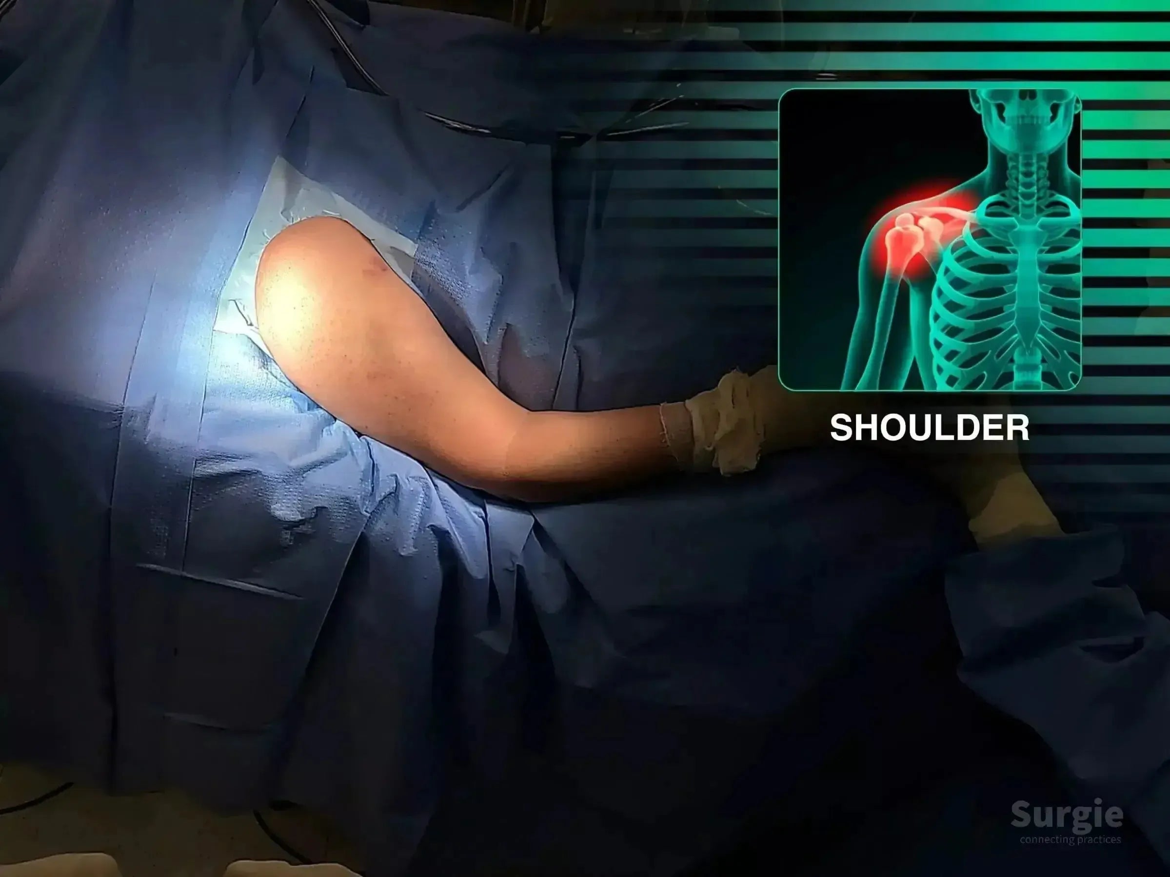 Surgical setup for proximal humerus fracture repair with an anatomical shoulder diagram overlay.