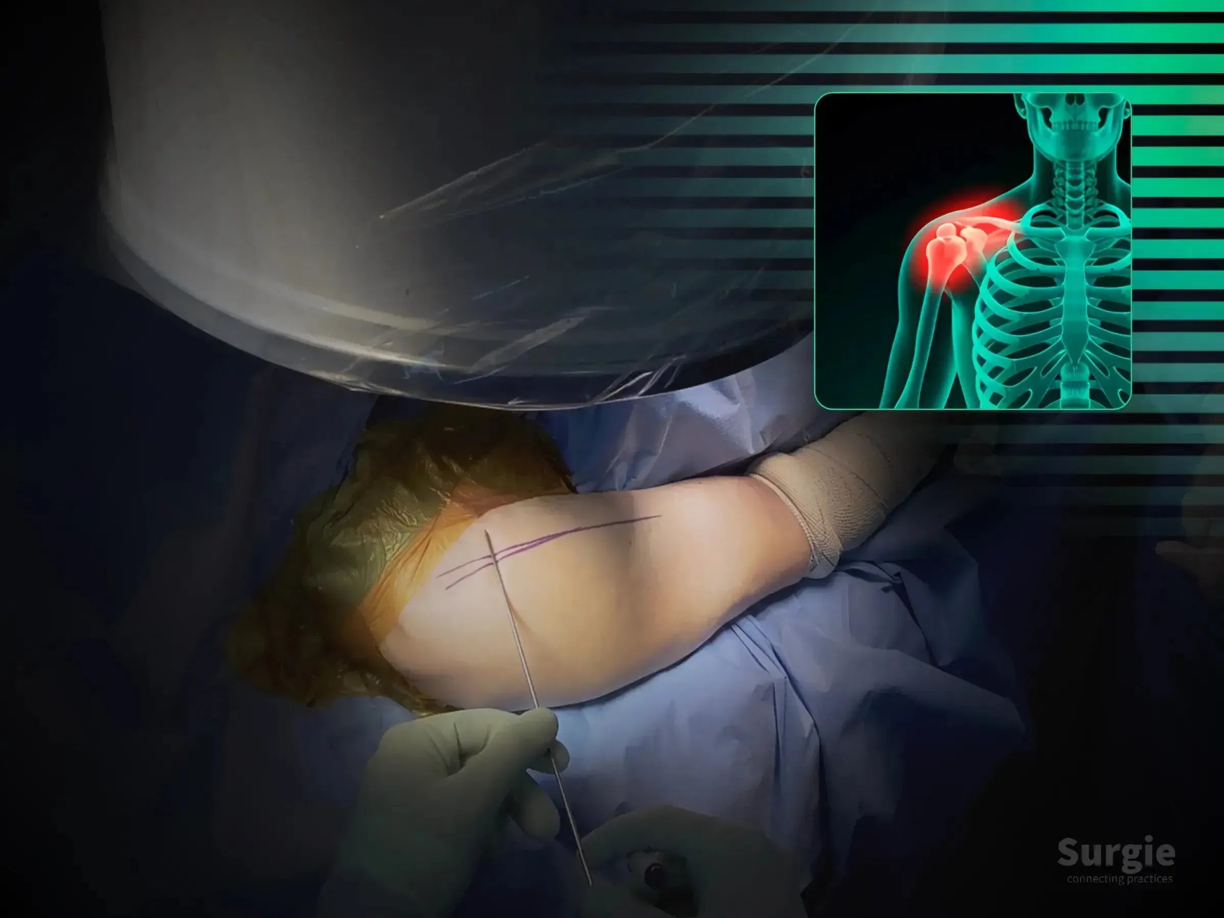Surgical guide wire insertion into a proximal humerus with an anatomical overlay showing a shoulder fracture.