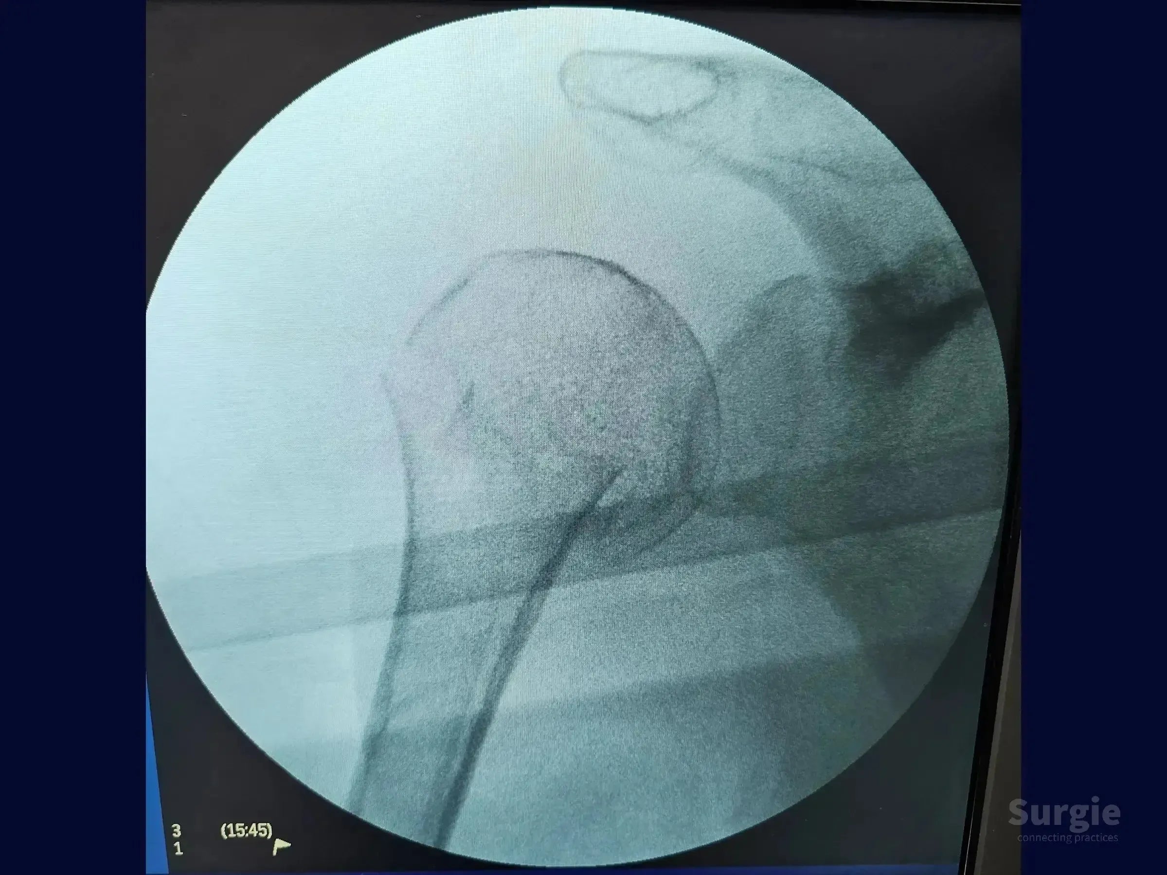 Fluoroscopic X-ray showing intramedullary nail placement in a proximal humerus fracture with joystick reduction technique.