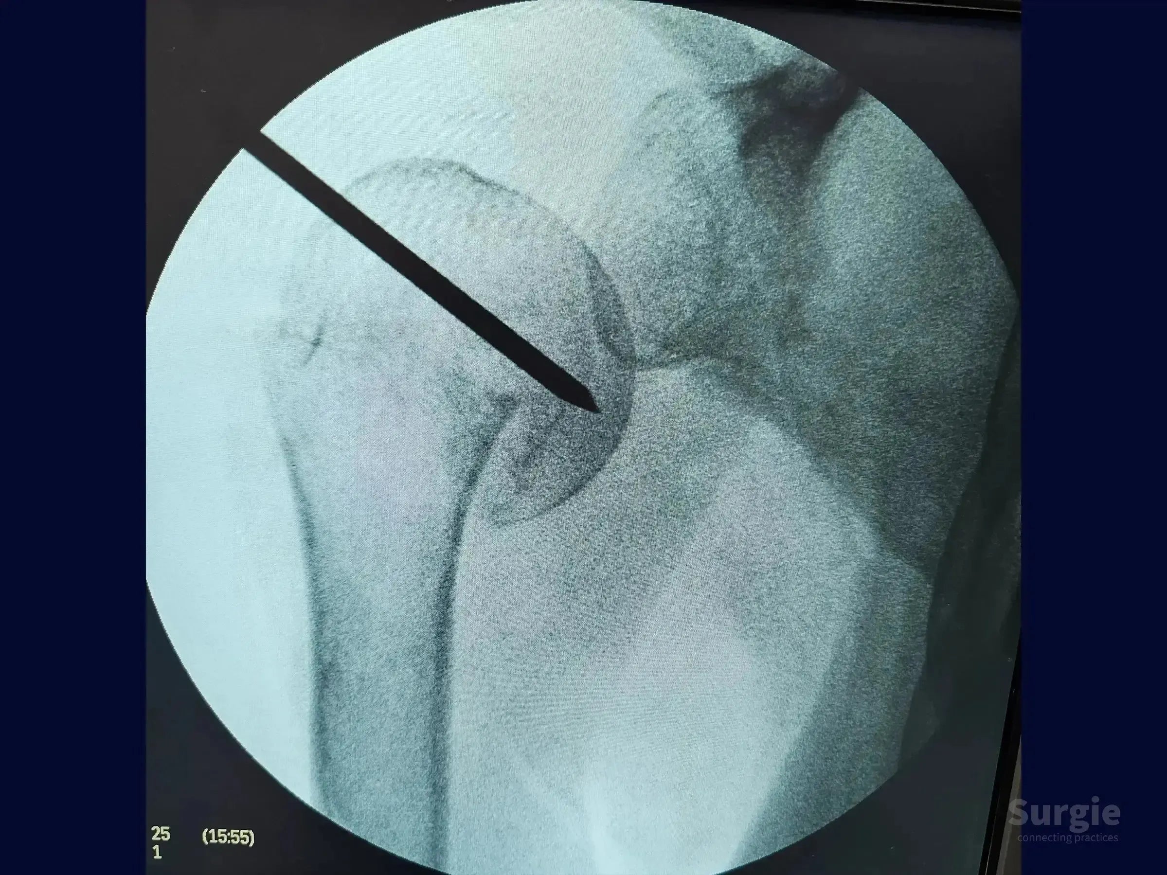Fluoroscopic view of a proximal humerus fracture with a guide wire positioned for intramedullary nail fixation.