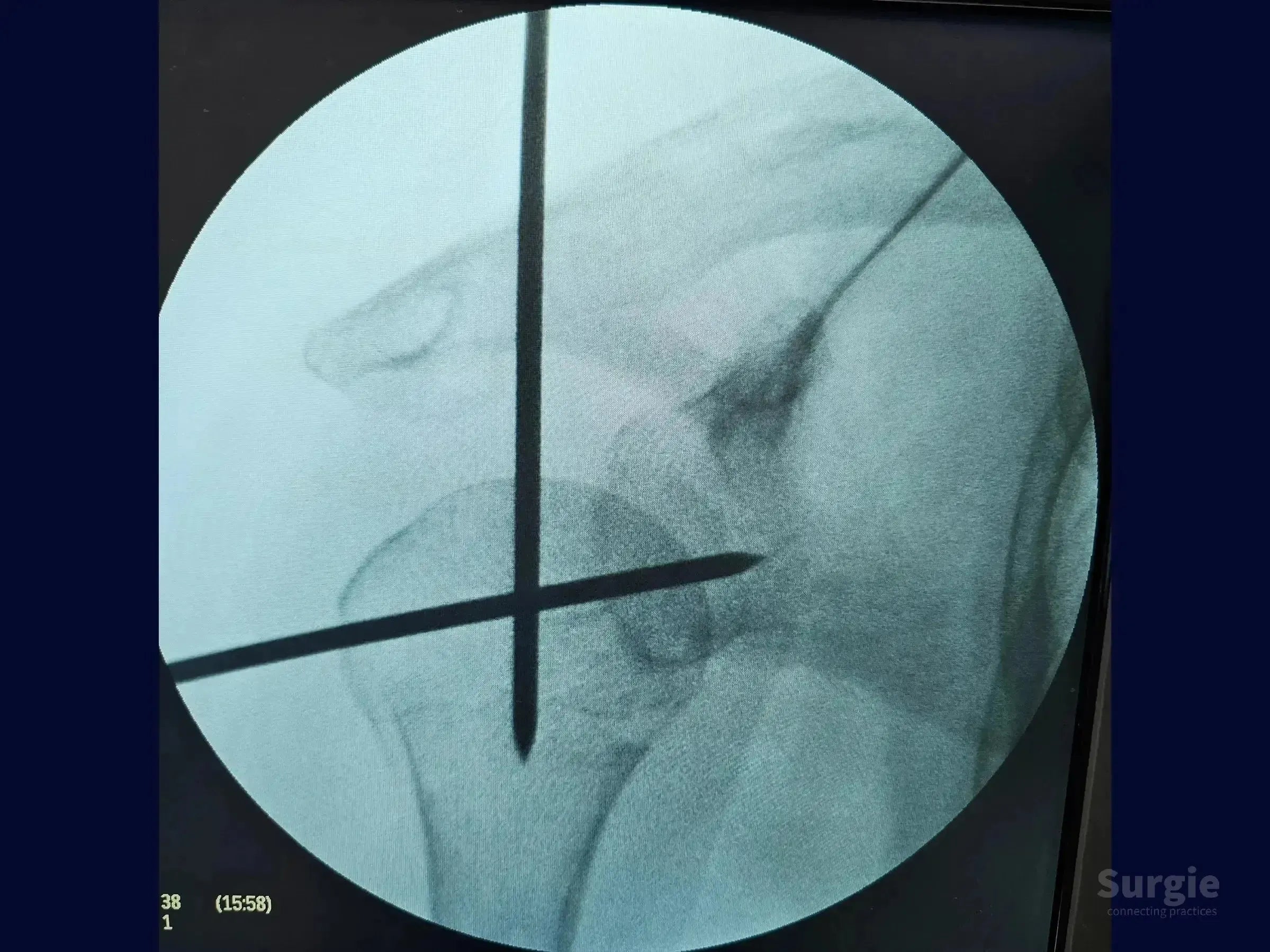 Fluoroscopic view of proximal humerus fracture fixation using two intersecting metal joystick guide wires.