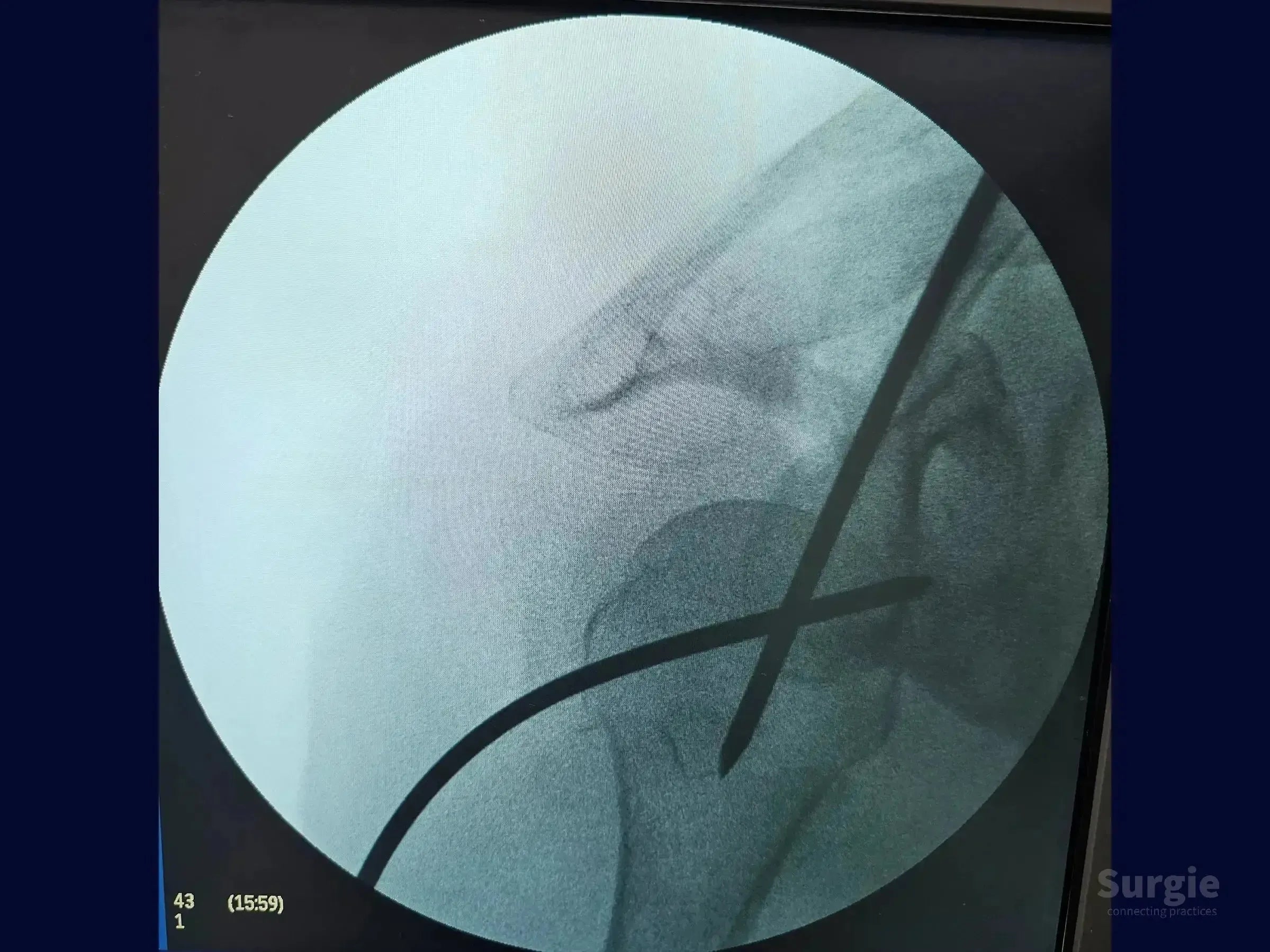 Fluoroscopic view of proximal humerus fracture fixation using a guide wire and joystick technique for fragment reduction.