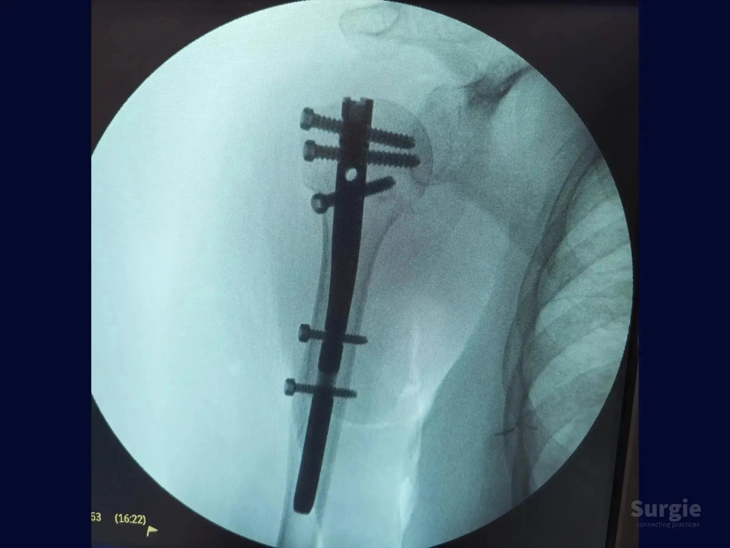 X-ray showing an intramedullary nail with proximal and distal locking screws securing a proximal humerus fracture.