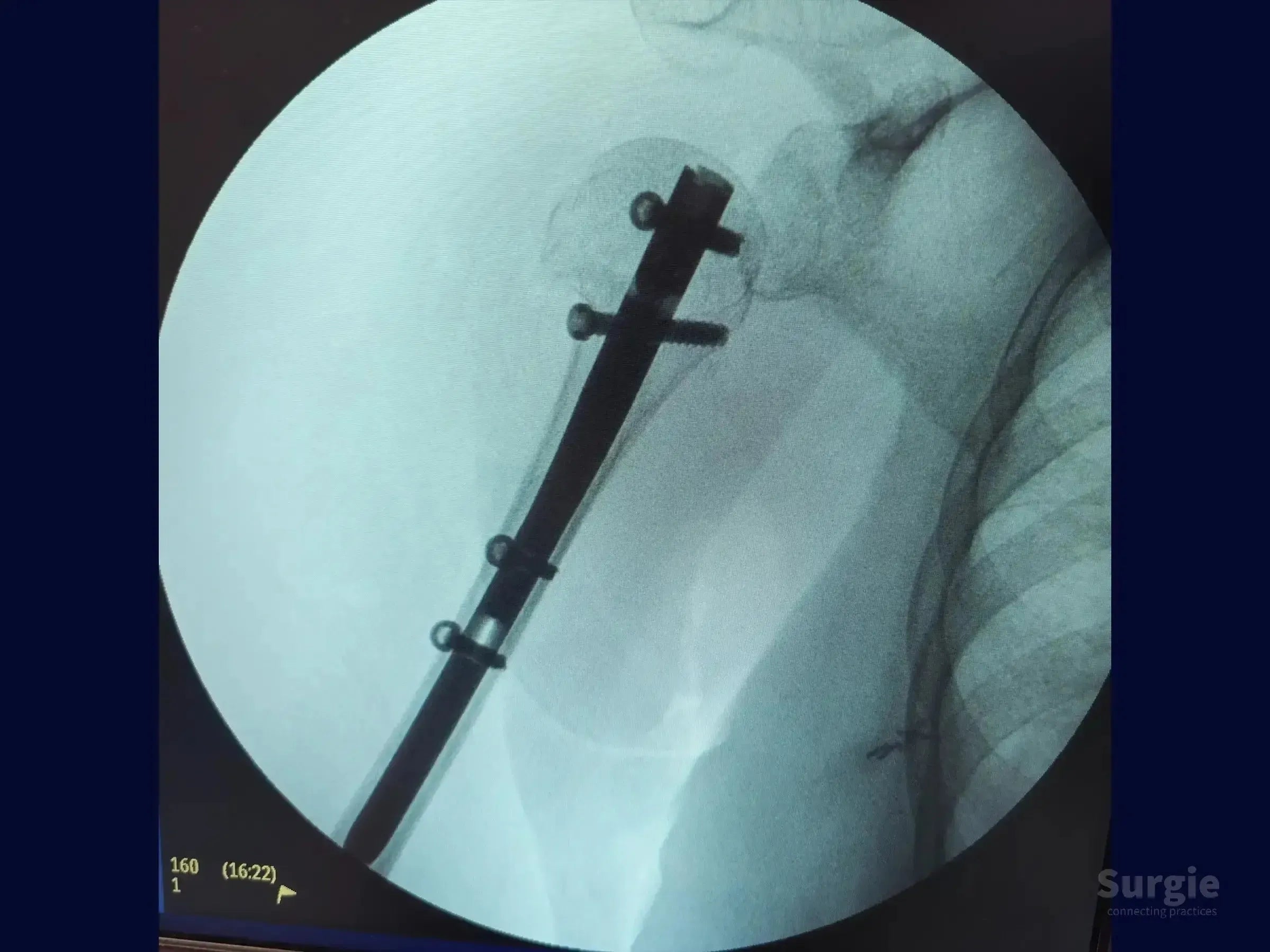 X-ray showing a metallic intramedullary nail fixed in a proximal humerus fracture with proximal and distal locking screws.