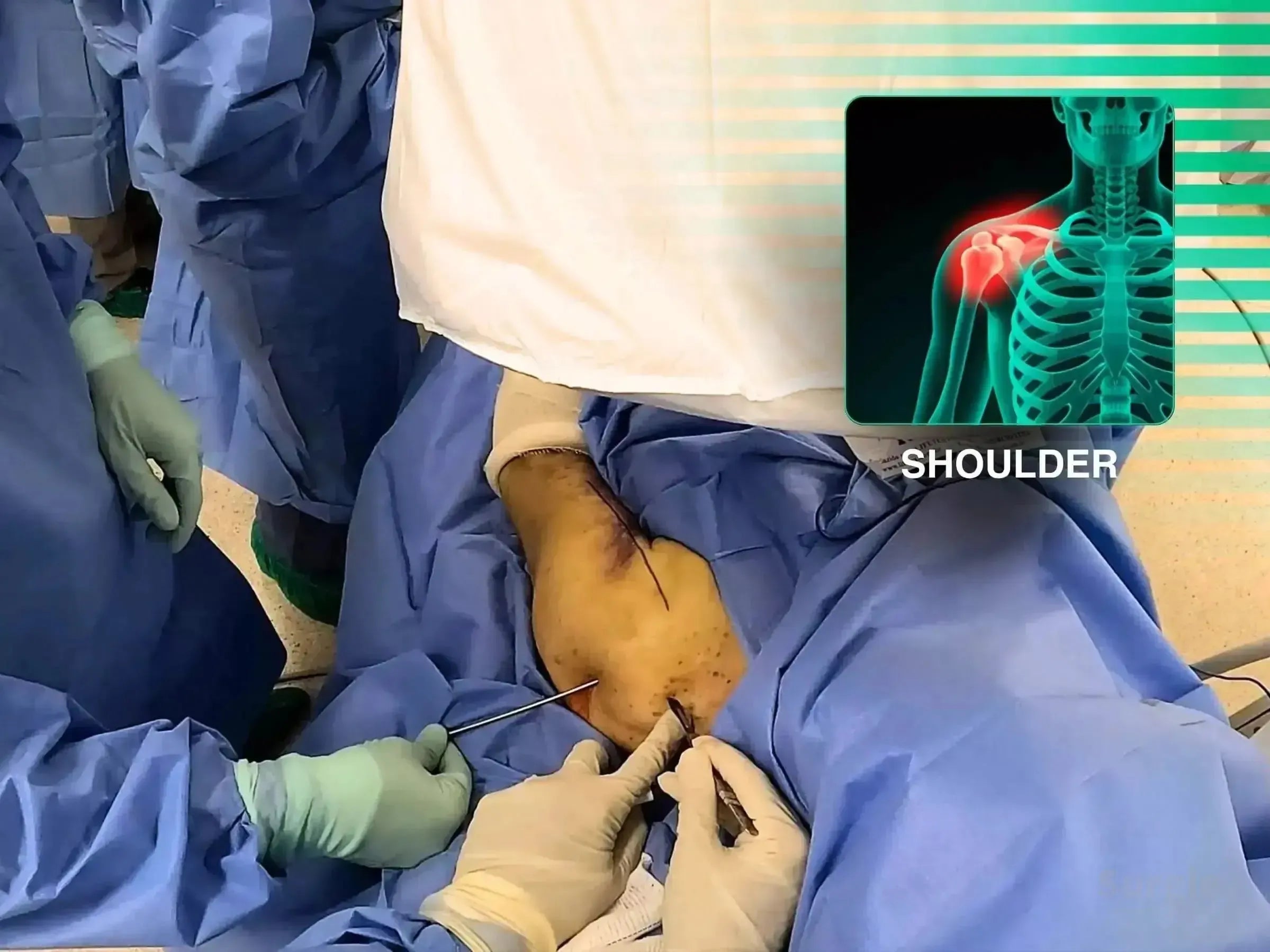 Surgeons performing minimally invasive intramedullary nailing on a humerus with a joystick technique and shoulder anatomy overlay.