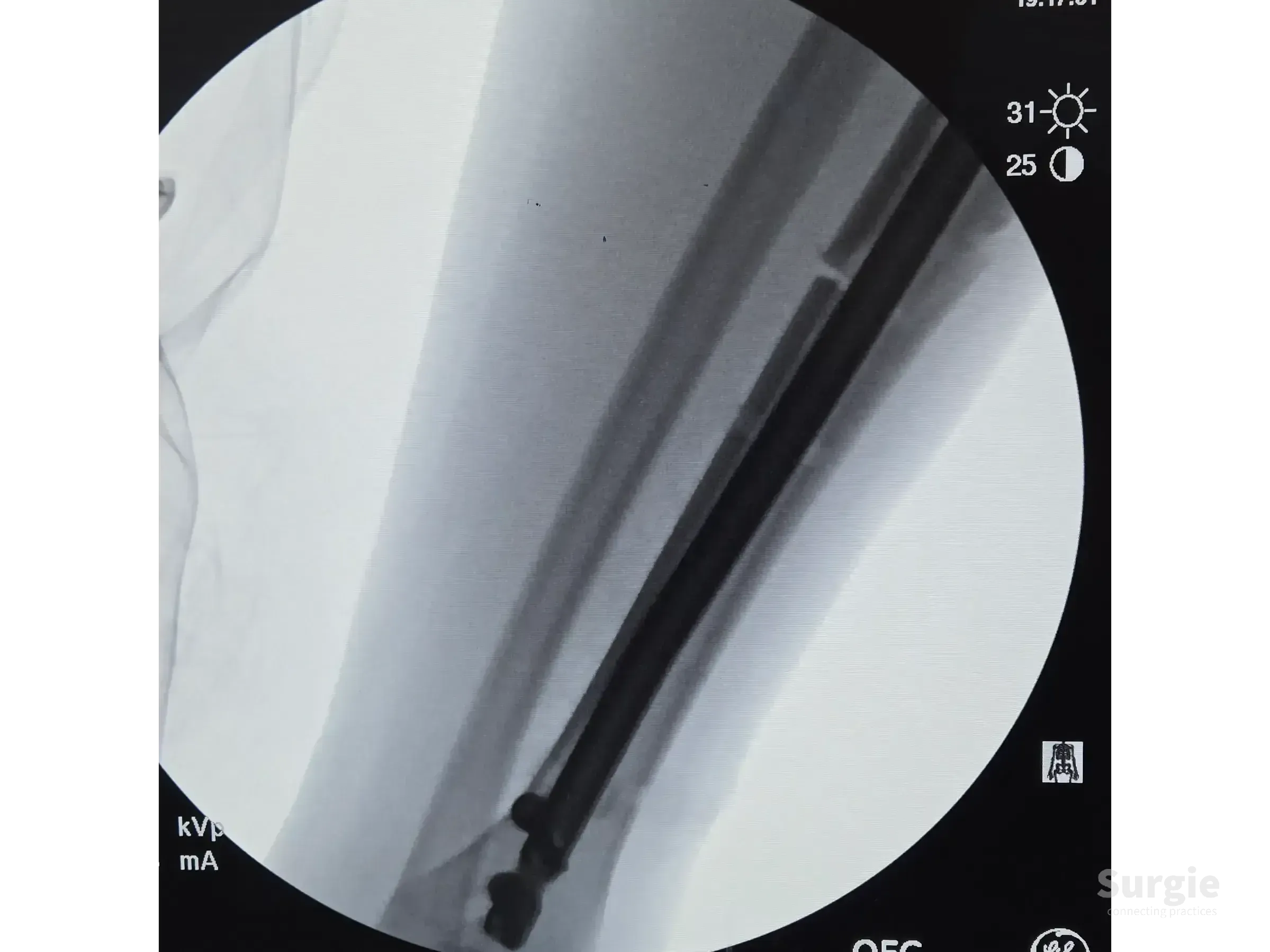 Fluoroscopic view of an intramedullary nail implanted in a tibial shaft fracture via an infrapatellar approach.