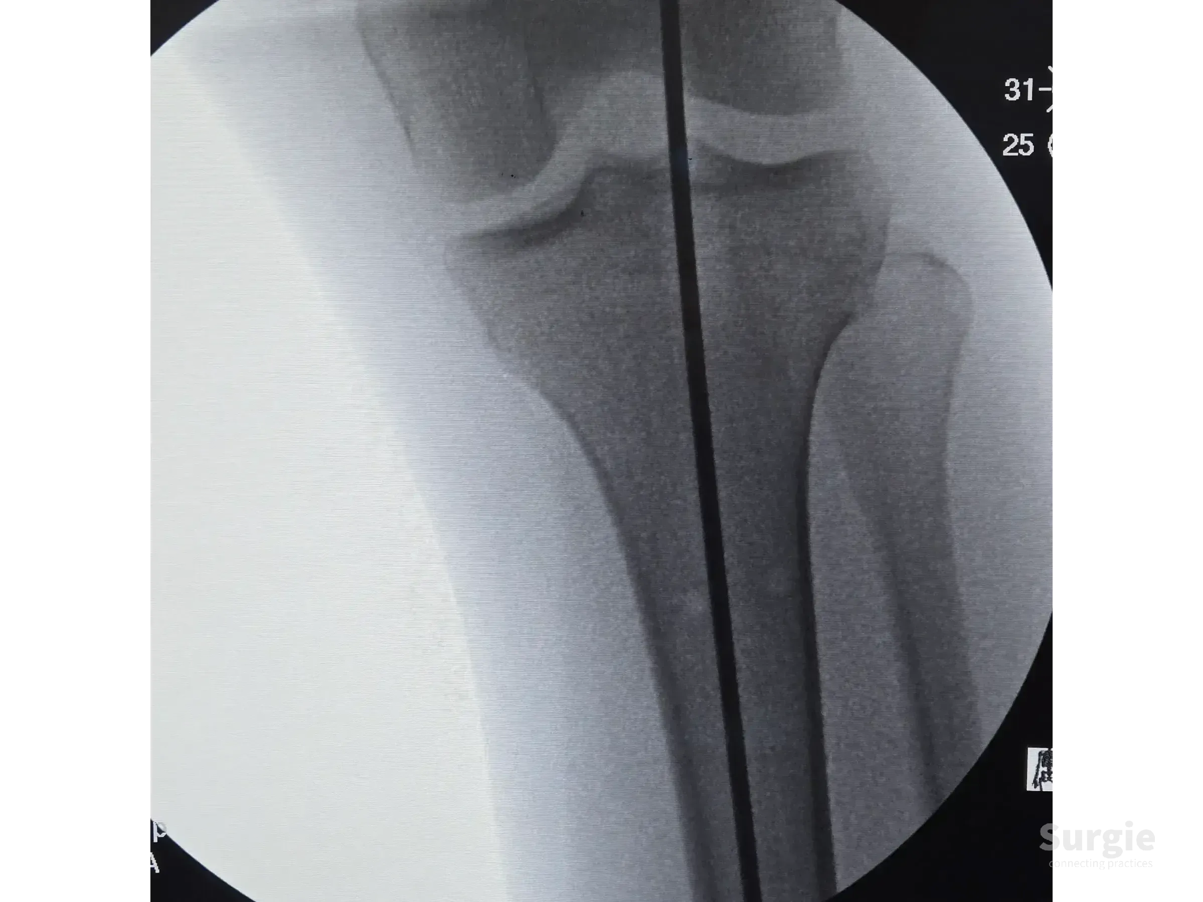 Fluoroscopic view of a guide wire positioned in the tibial canal for infra-patellar intramedullary nailing.