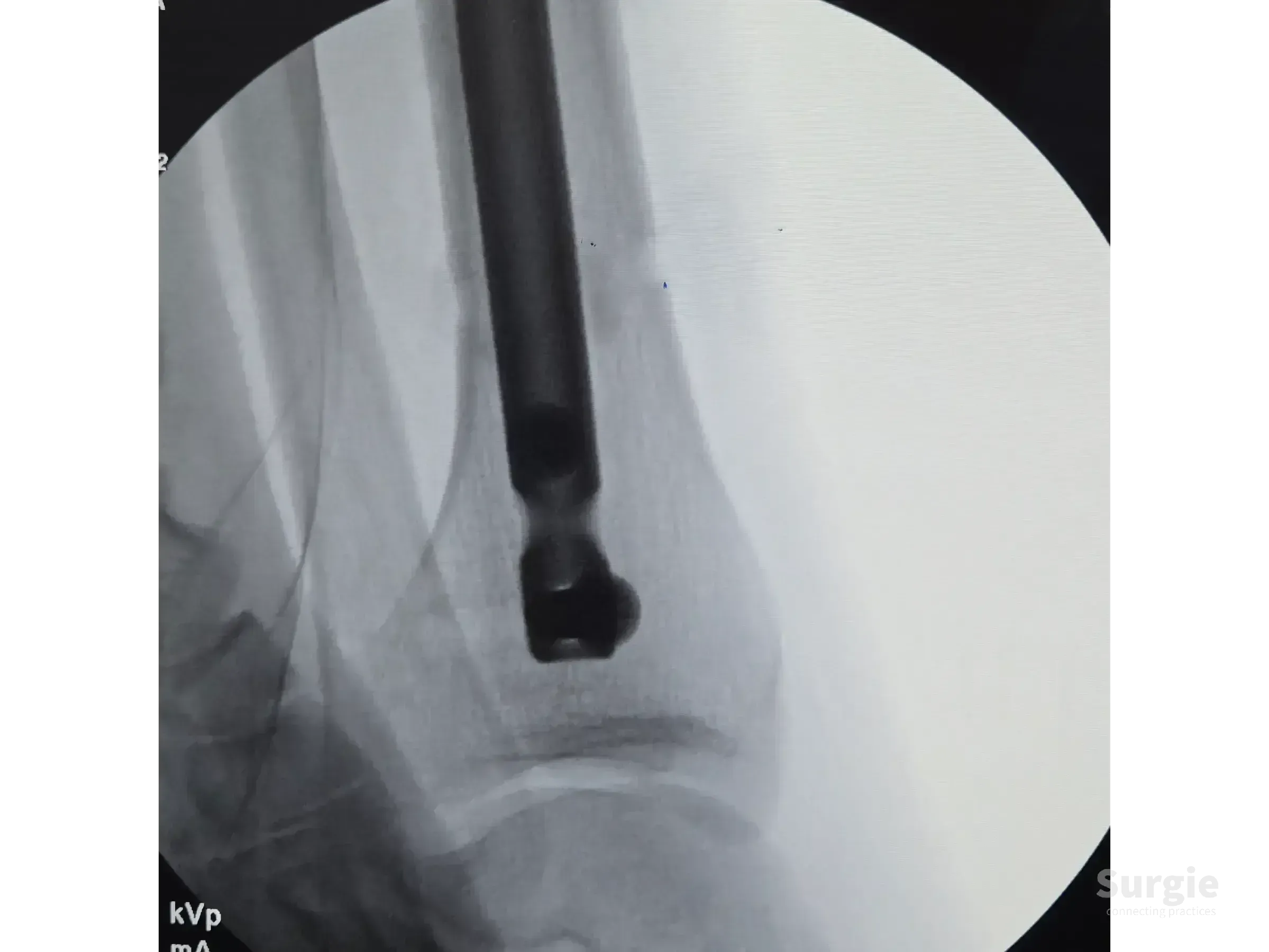 Fluoroscopic view of a metallic intramedullary nail inserted into a tibial shaft during orthopedic surgery.
