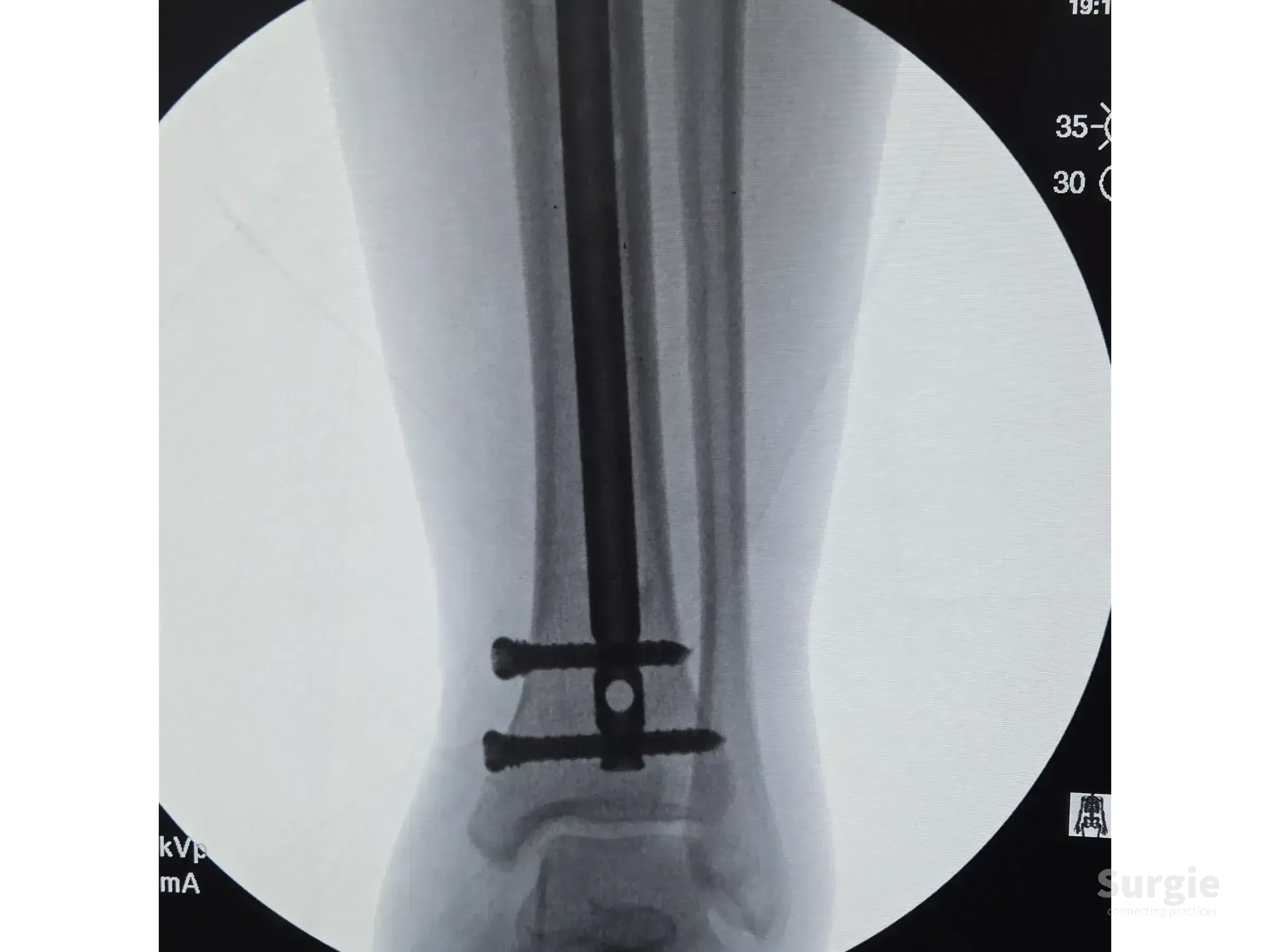 X-ray showing an intramedullary tibial nail with two distal locking screws in the distal tibia shaft.