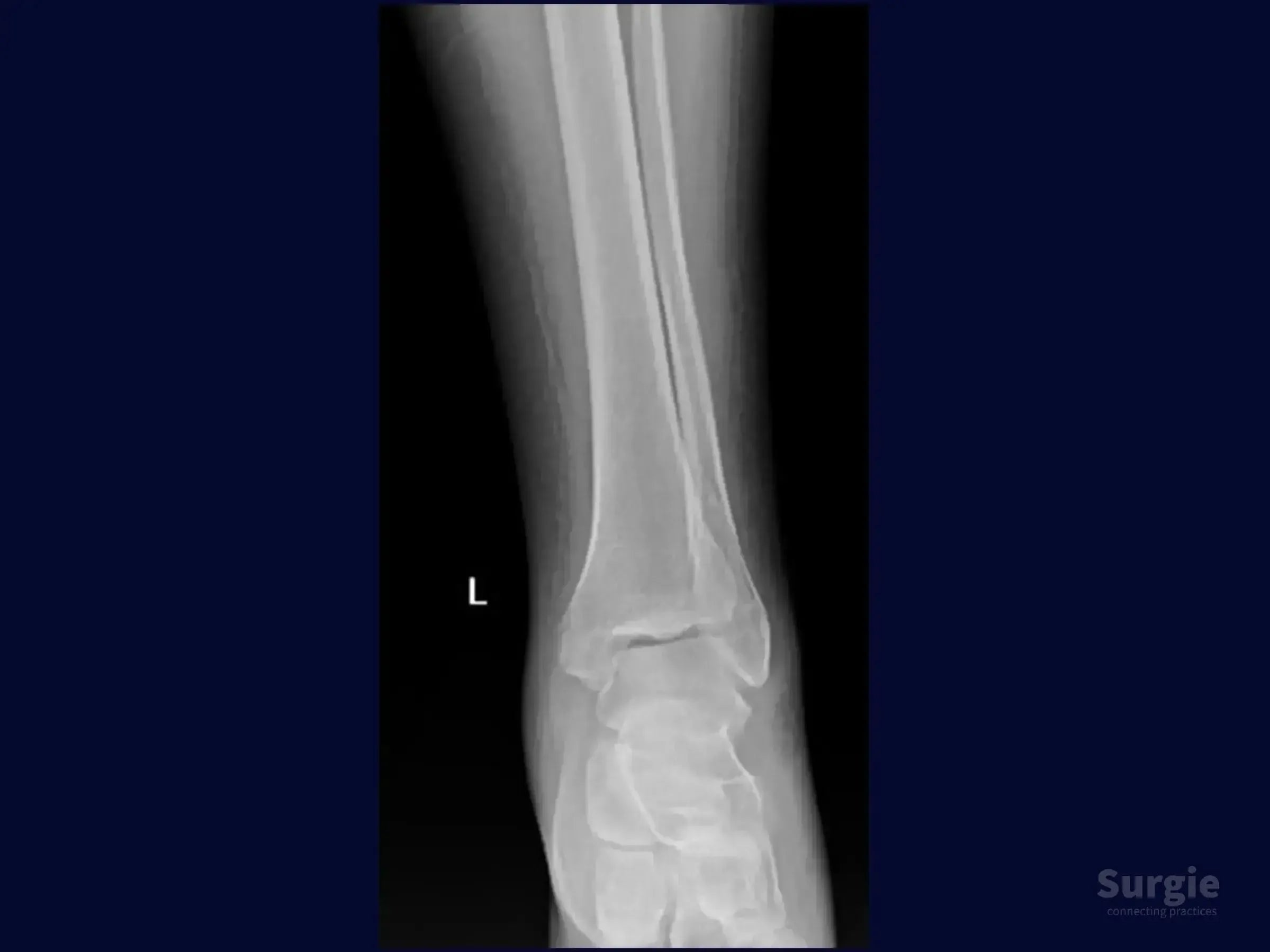 Anteroposterior X-ray of a left ankle showing a lateral malleolus fracture with a multifragmentary component.
