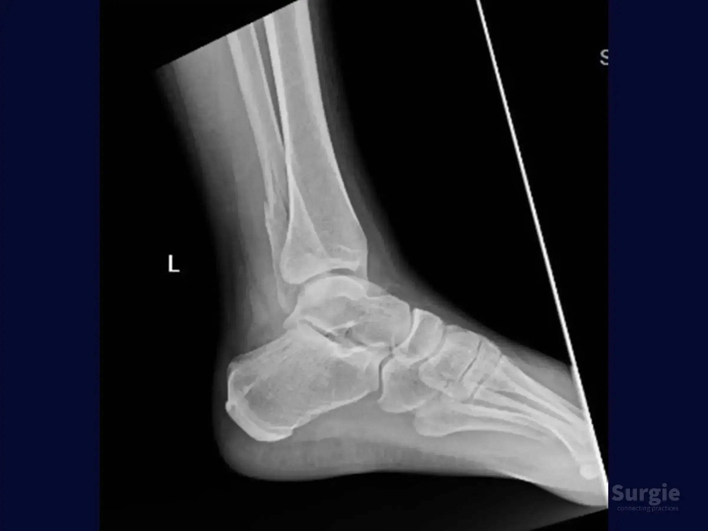 Lateral X-ray of a left ankle showing a multifragmentary lateral malleolus fracture with bone displacement.
