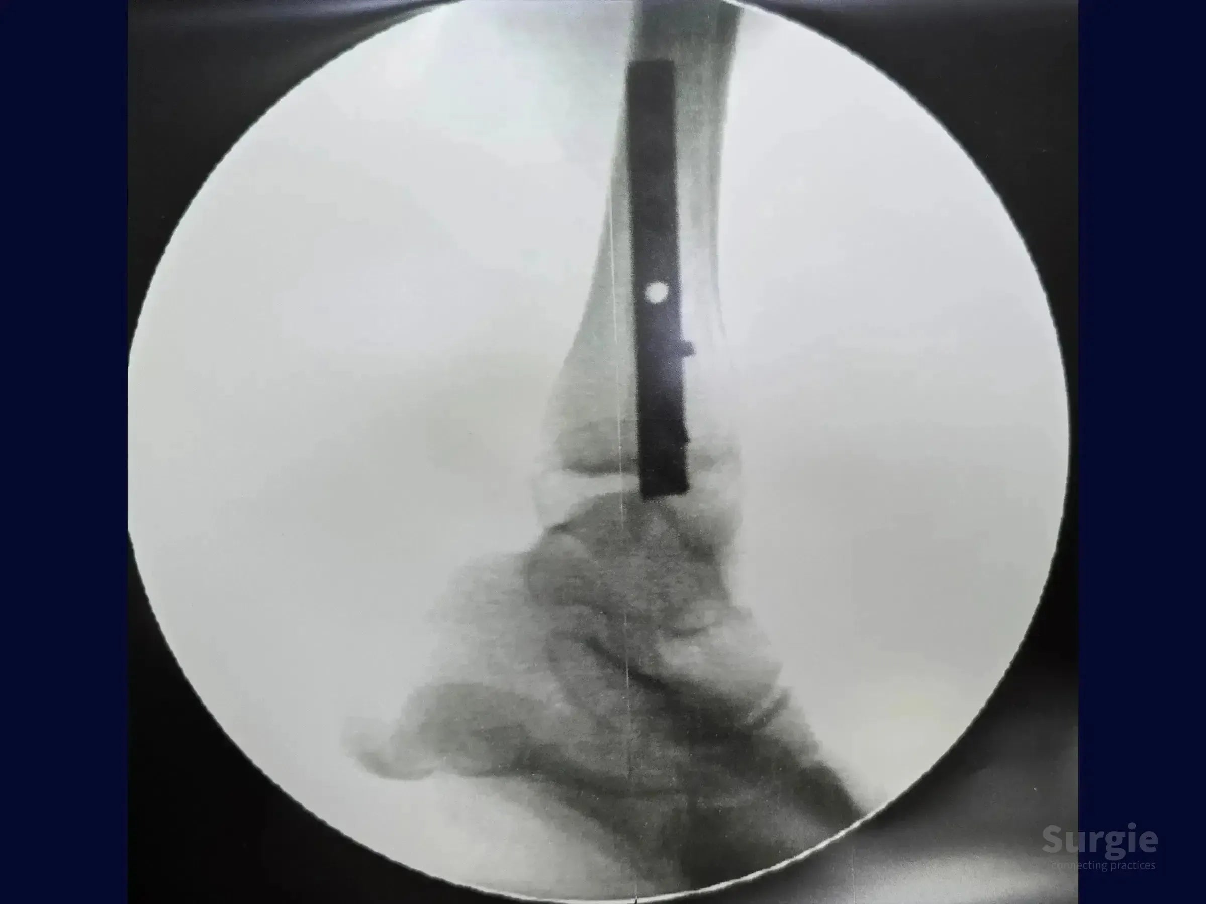 X-ray showing a metal posterior plate fixed to a lateral malleolus fracture for surgical stabilization.