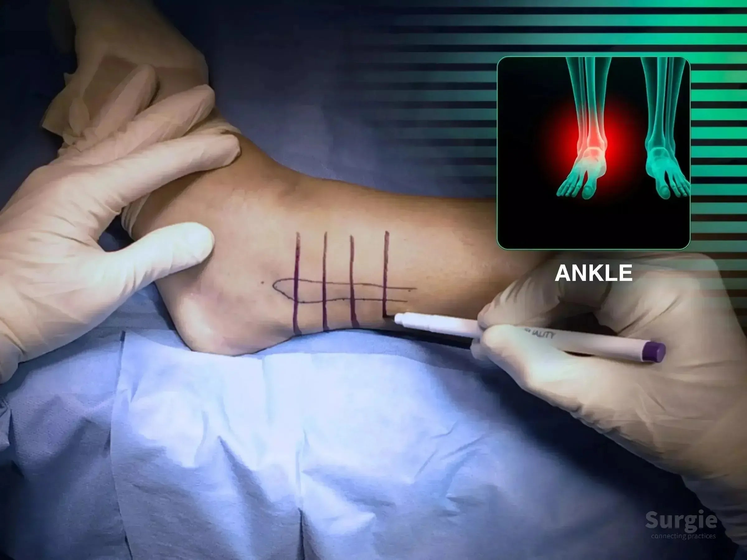 Surgeon marking a lateral malleolus fracture site on an ankle with a medical marker, featuring an anatomical overlay.