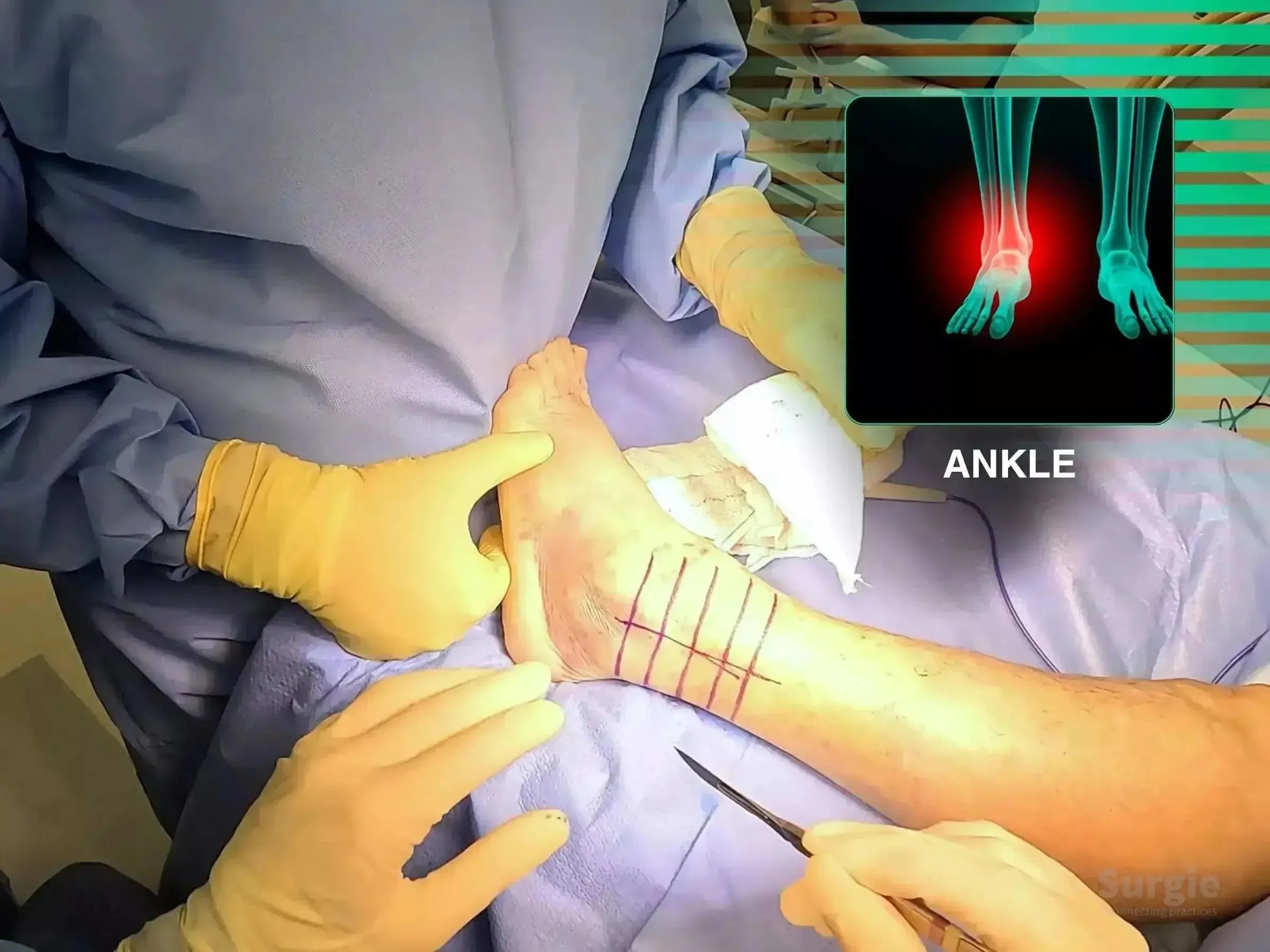 Surgeon marking a patient's ankle for lateral malleolus fracture surgery with an anatomical X-ray overlay.