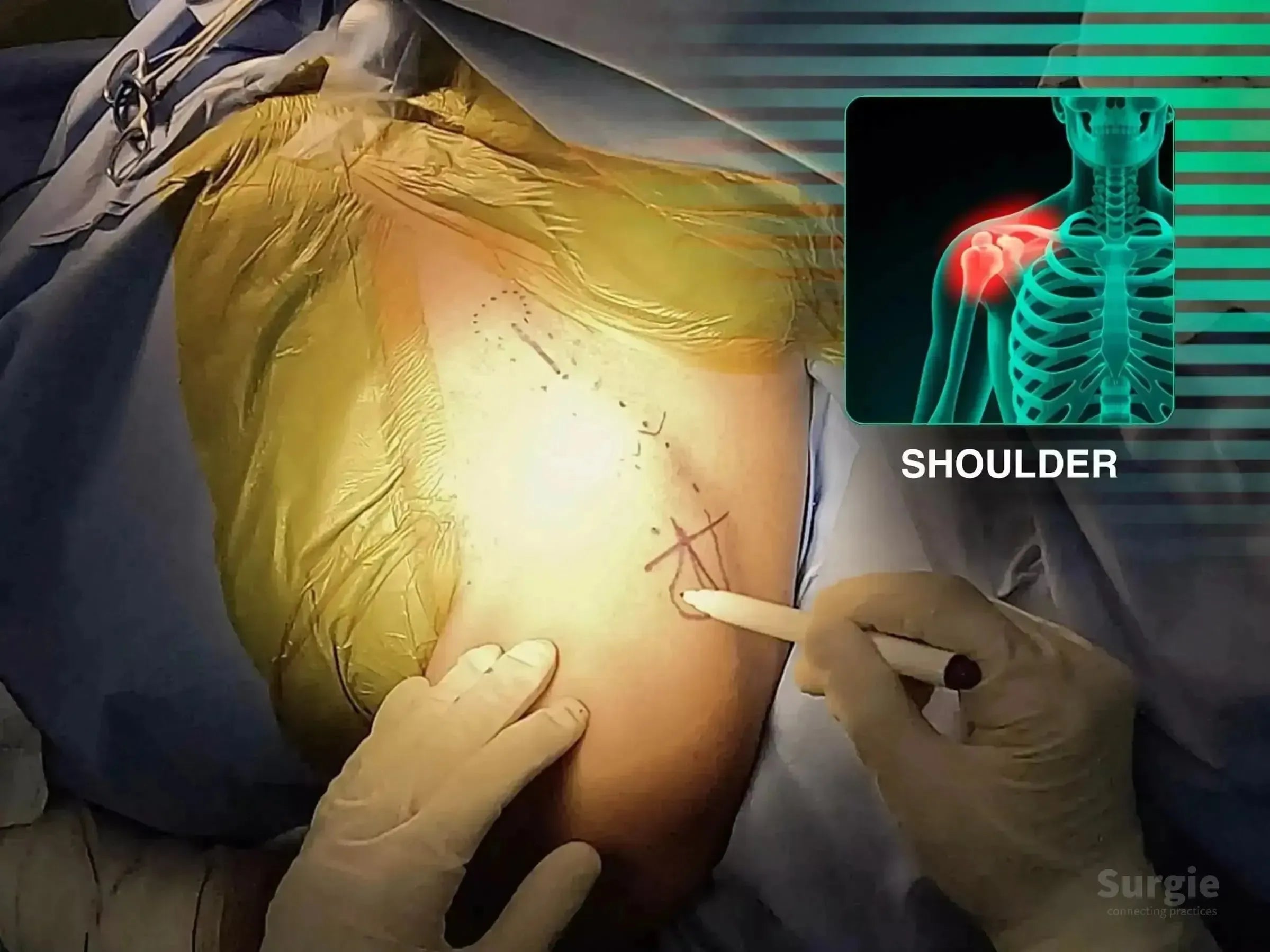 Surgeon marking skin for minimally invasive clavicle bridge plating with anatomical shoulder diagram overlay.