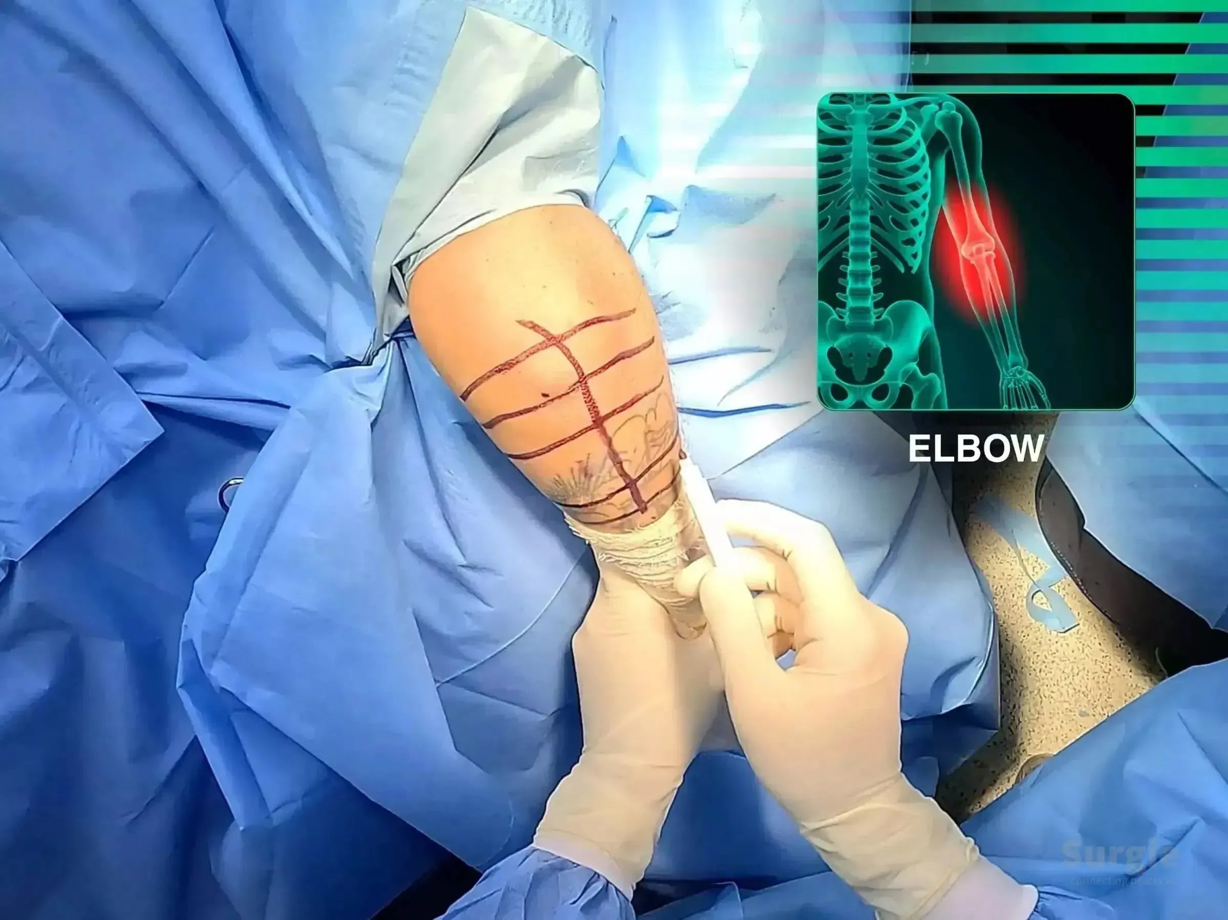 Surgeon marking an elbow for minimally invasive osteosynthesis with an anatomical skeletal overlay.