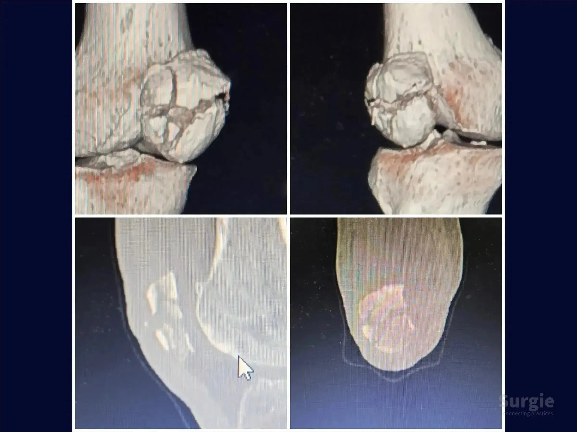 3D CT scan showing a multi-fragmentary patella fracture with displaced bone segments and articular surface disruption.