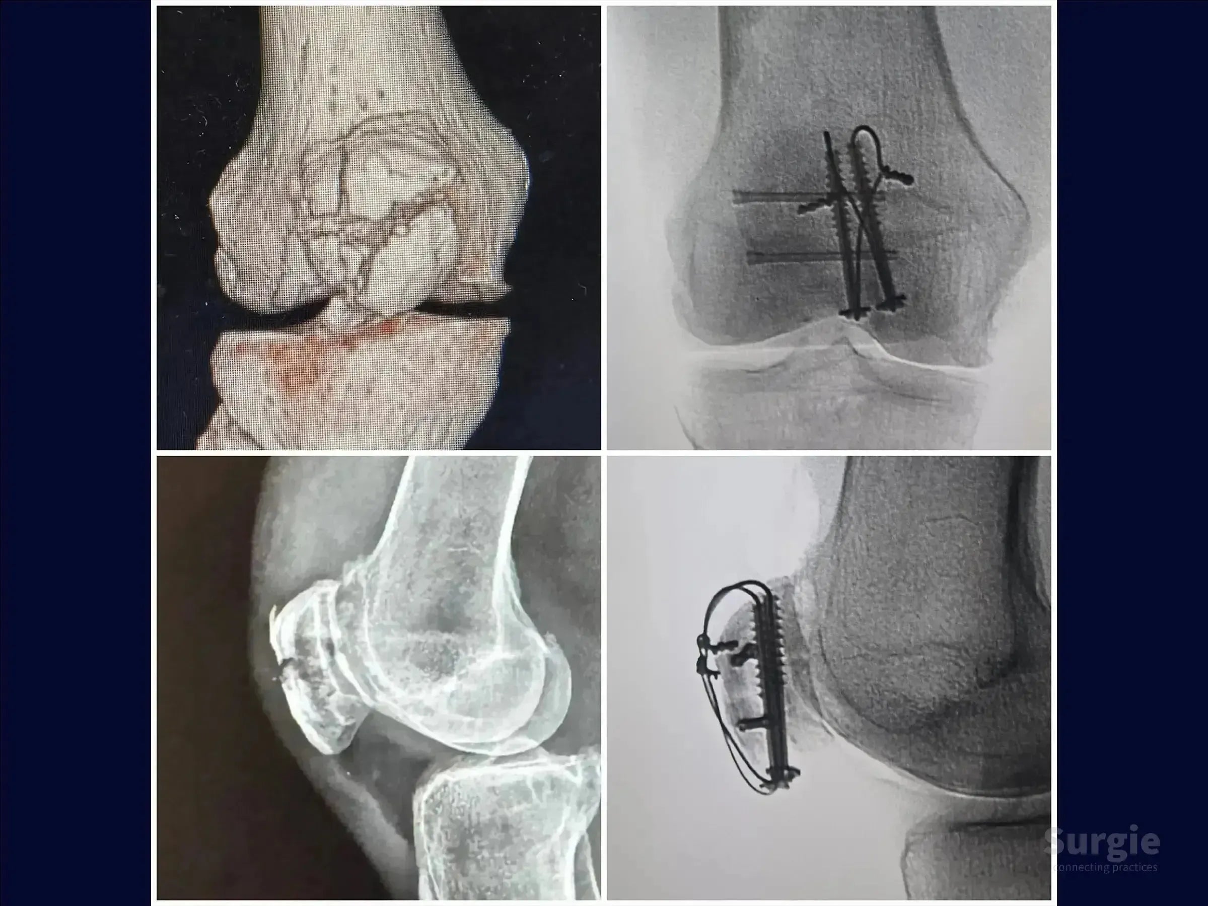 X-ray views showing surgical repair of a multi-fragmentary patella fracture using cannulated screws and cerclage wiring.