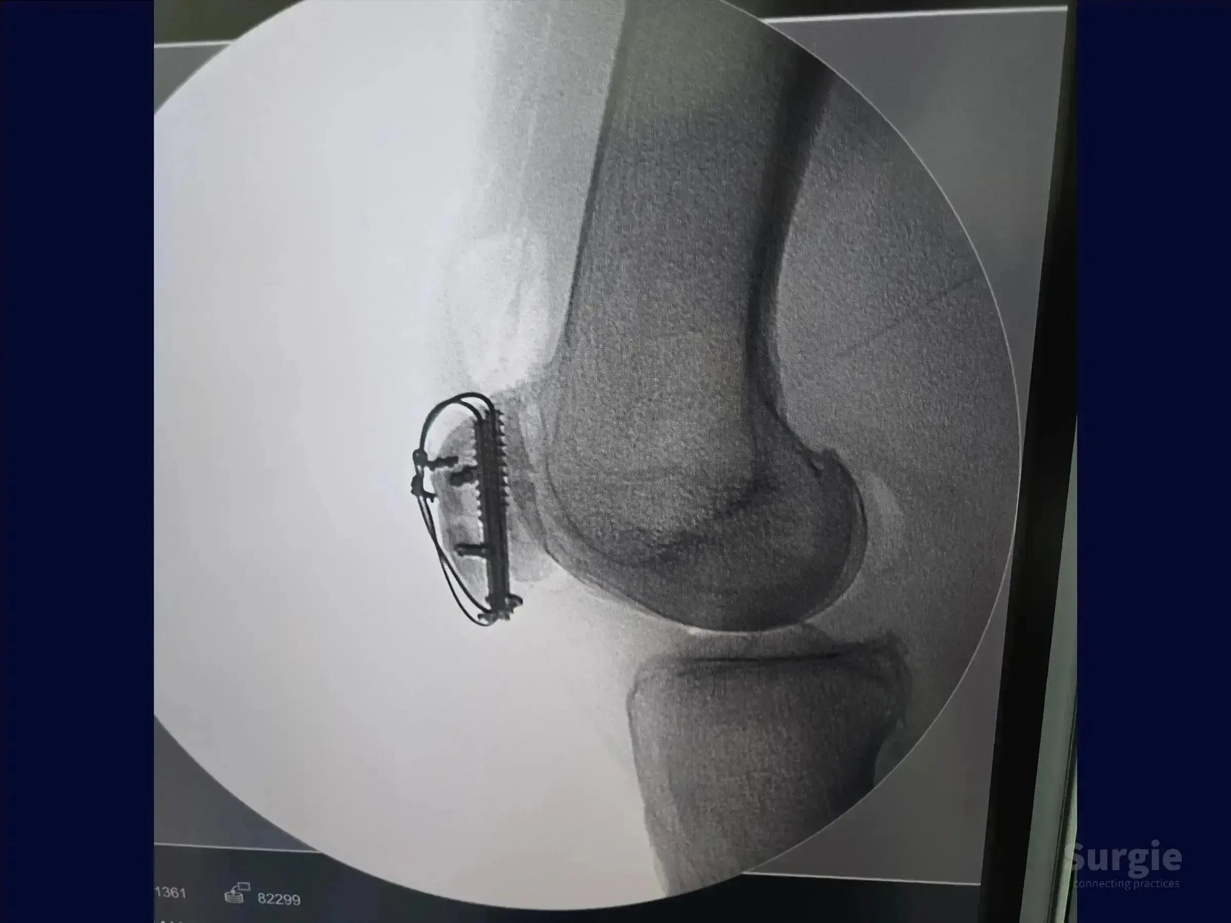 Lateral X-ray showing patella fracture fixation with a metallic plate, cannulated screws, and tension band cerclage wiring.