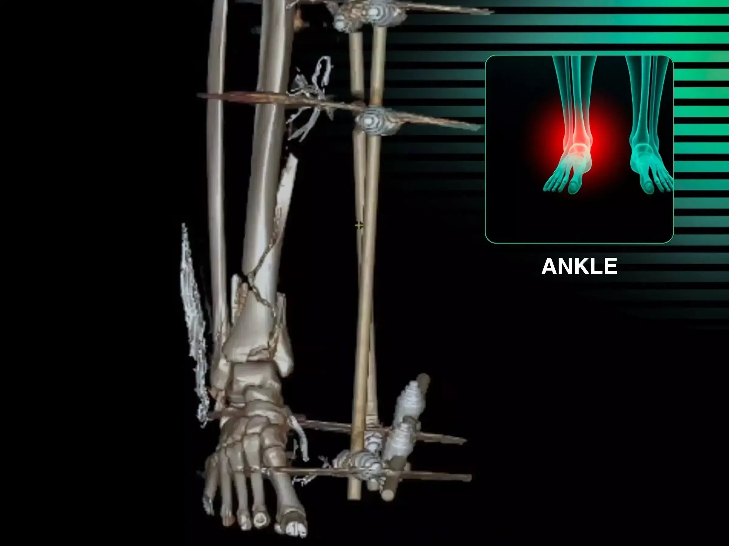 Multi-fragmentary Tibial Pilon Fracture (High-Energy Trauma)