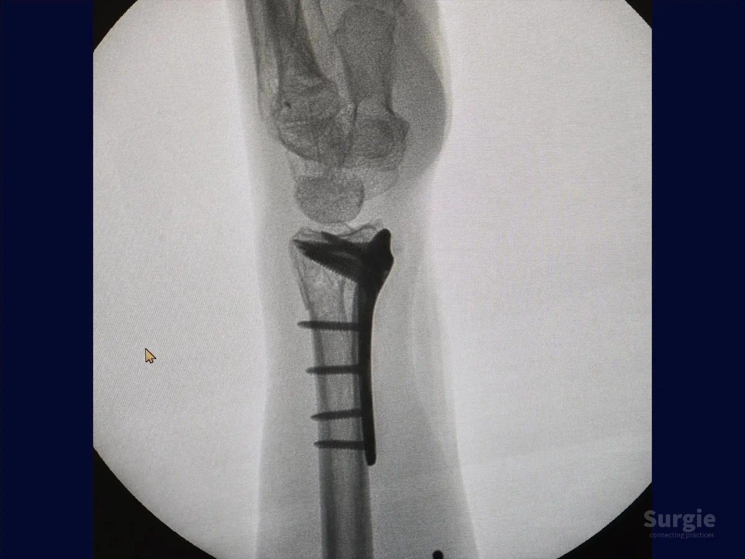 X-ray showing a distal radius fracture stabilized with a volar plate and multiple screws for fragment fixation.