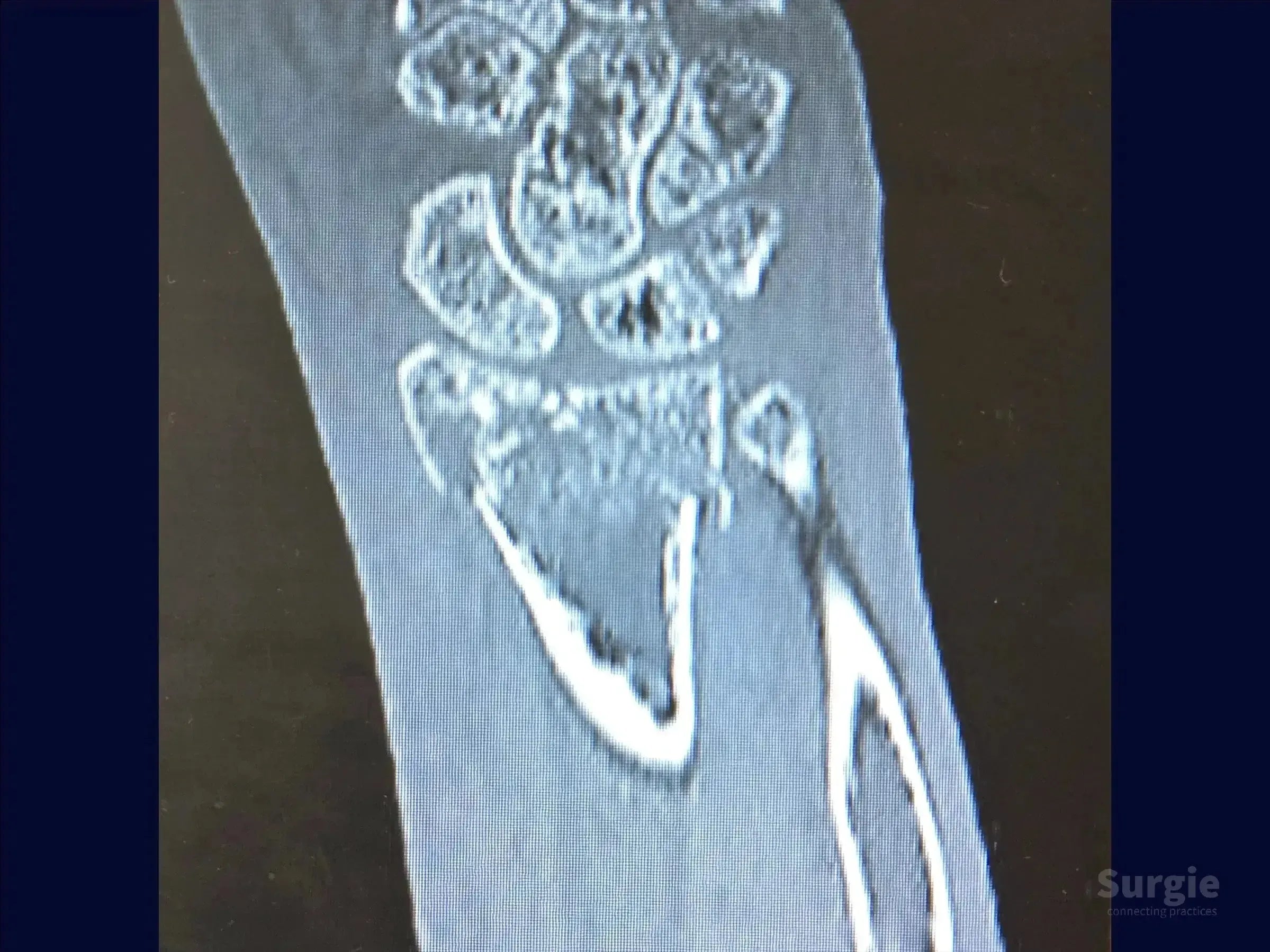 Grayscale CT scan showing a multifragmentary distal radius fracture with articular displacement and bone fragments.