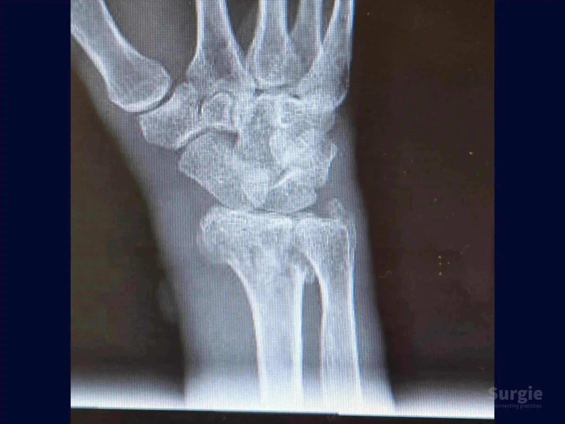 X-ray showing a multifragmentary distal radius fracture with articular displacement and bone fragmentation.