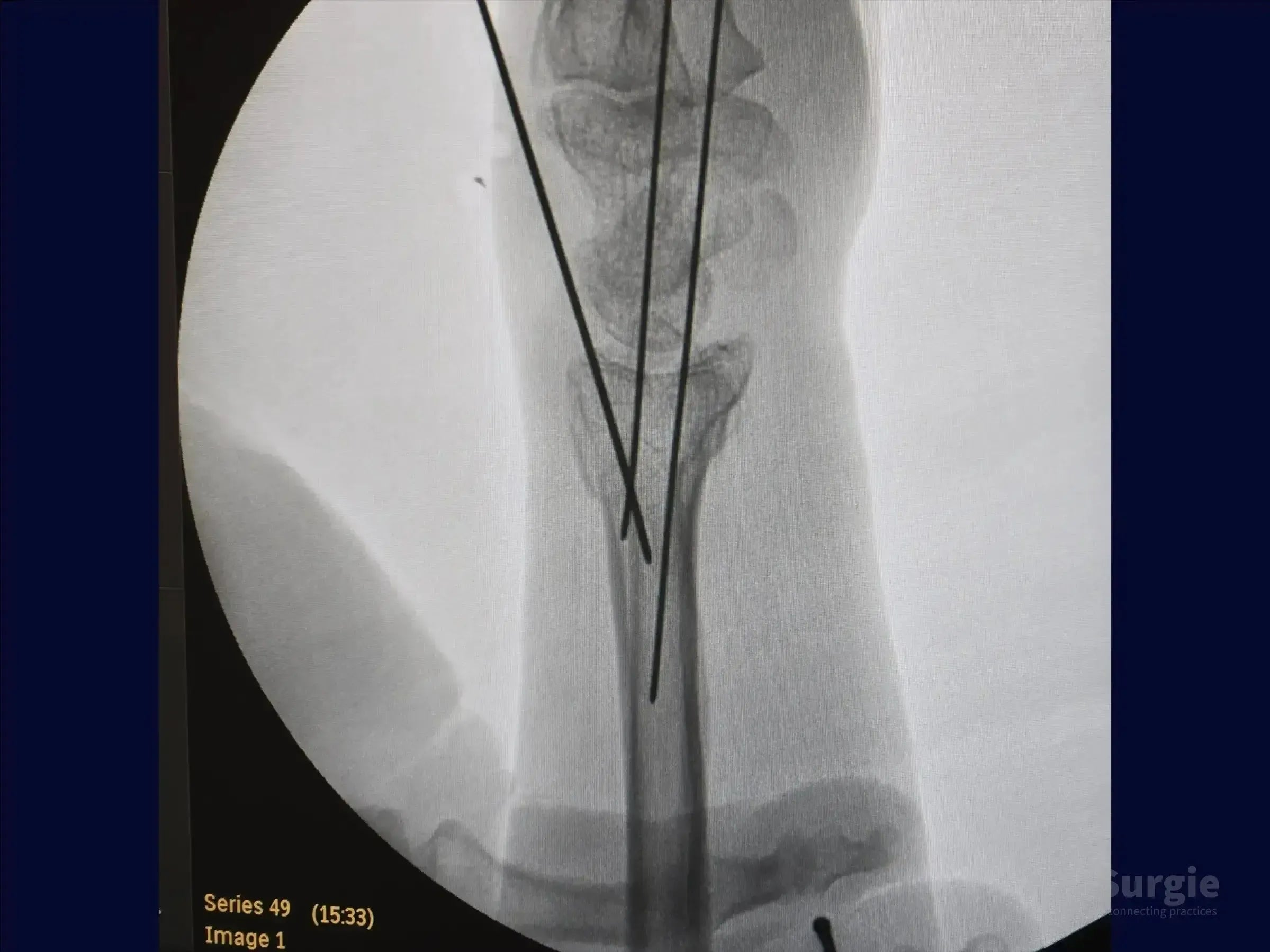 X-ray showing percutaneous K-wire fixation of a multifragmentary distal radius fracture during volar reduction.