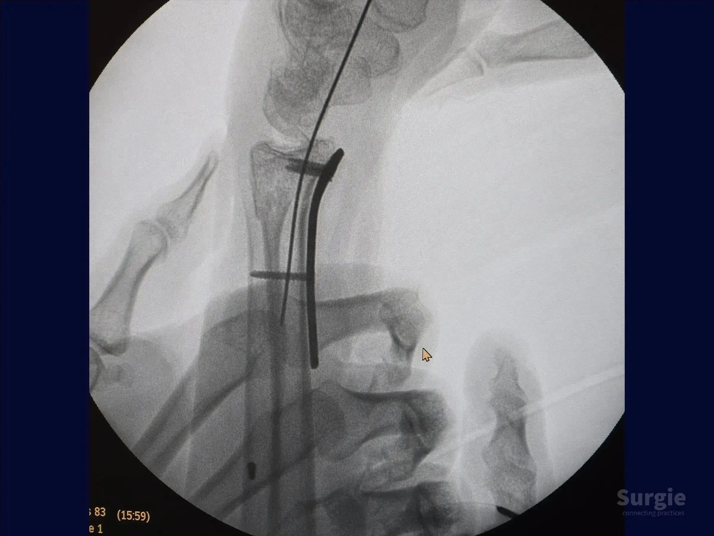 X-ray showing a volar plate and percutaneous pins stabilizing a multifragmentary distal radius fracture.