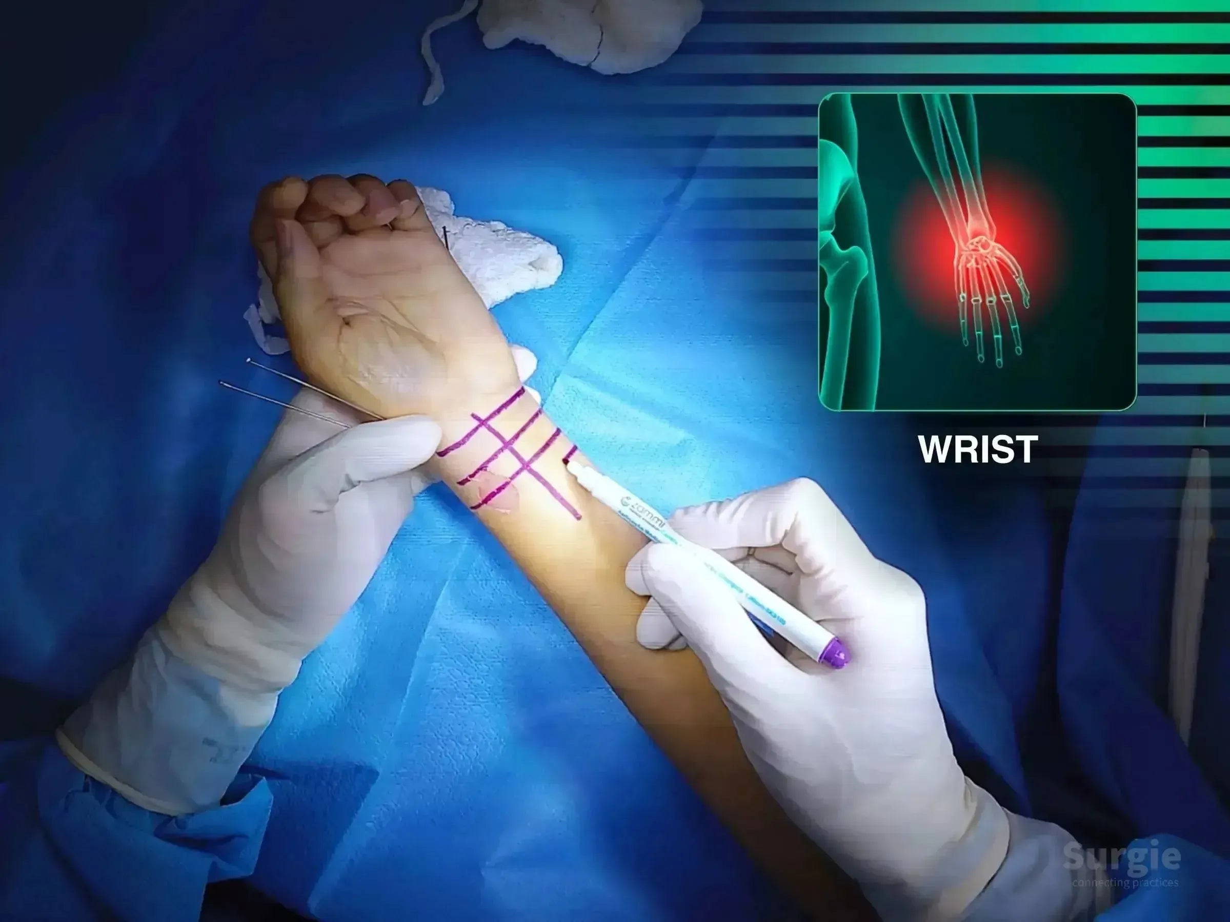 Surgeon marking a patient's wrist for volar approach surgery with a digital anatomical overlay of the distal radius.
