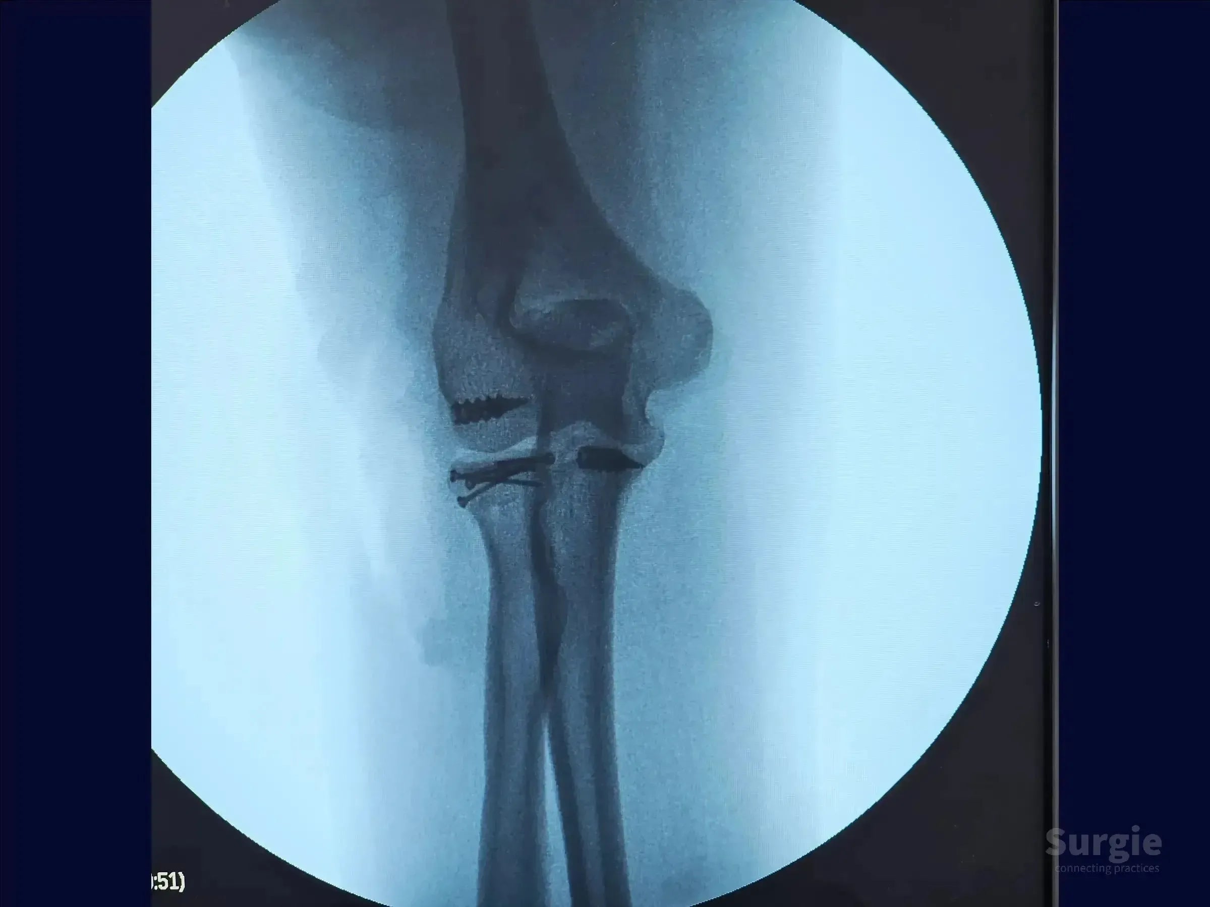 X-ray of a Mason 3 radial head fracture stabilized with metallic screws and plates in the elbow joint.