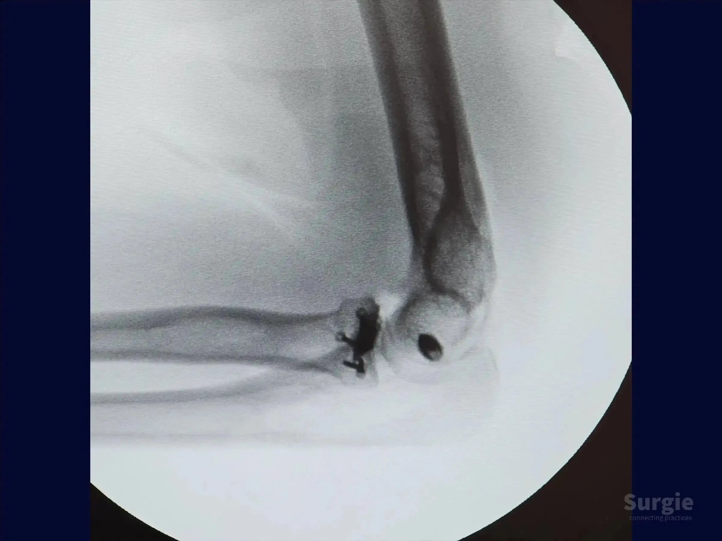X-ray showing a Mason 3 multifragmentary radial head fracture with surgical fixation hardware in the elbow joint.