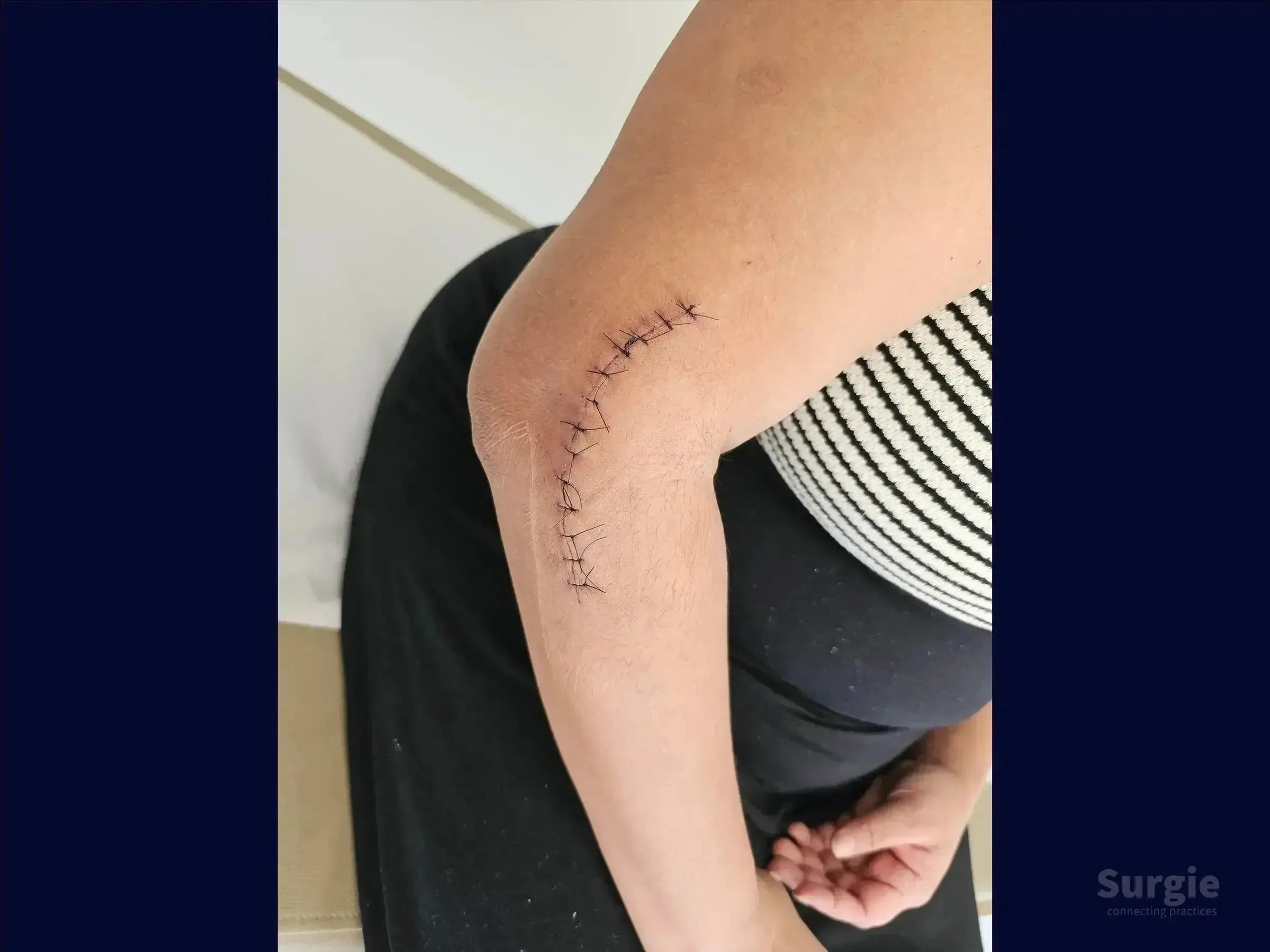 Curved surgical incision on a human elbow closed with black interrupted sutures following radial head fracture repair.