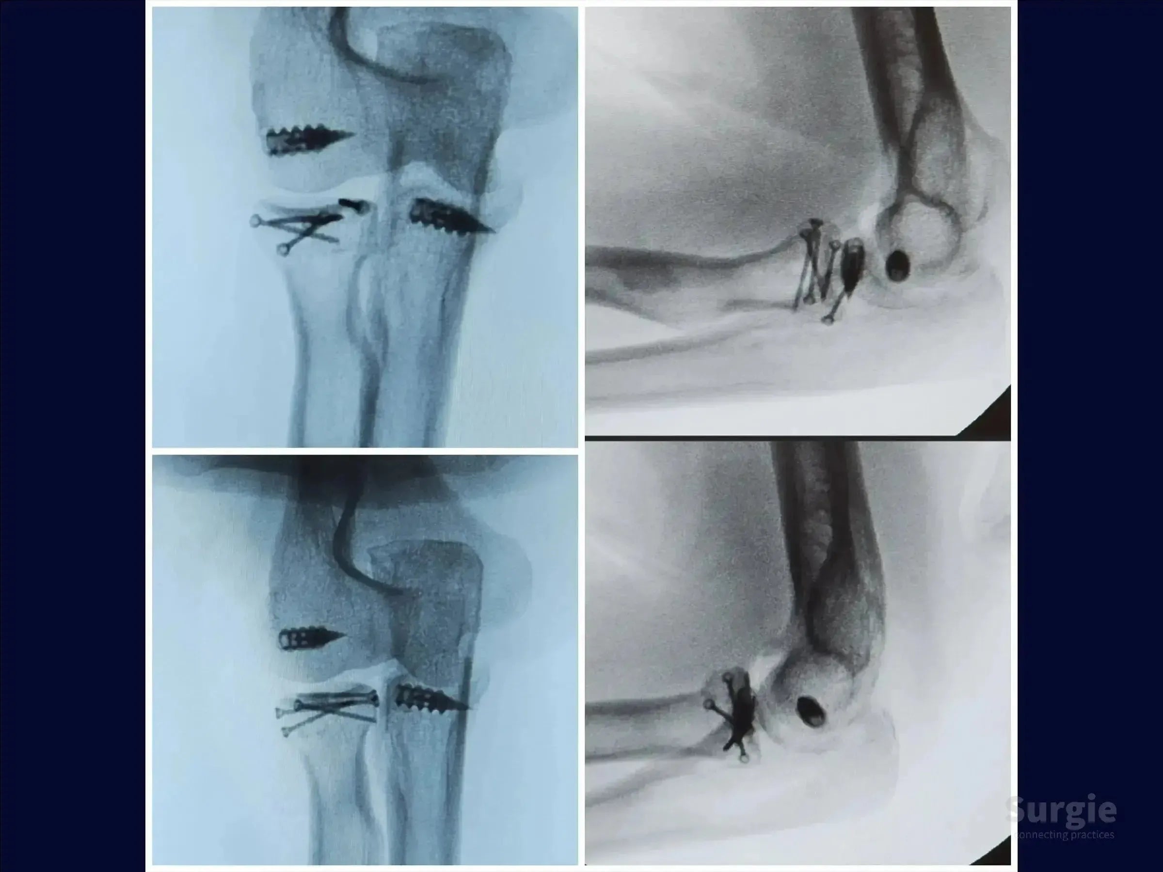 X-ray showing Mason 3 radial head fracture fixation with metal screws and hardware in the elbow joint.