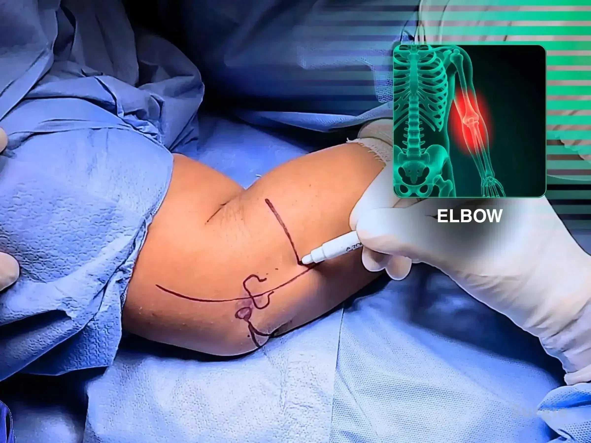Surgeon marking a patient's elbow for surgery with an anatomical overlay showing a radial head fracture.