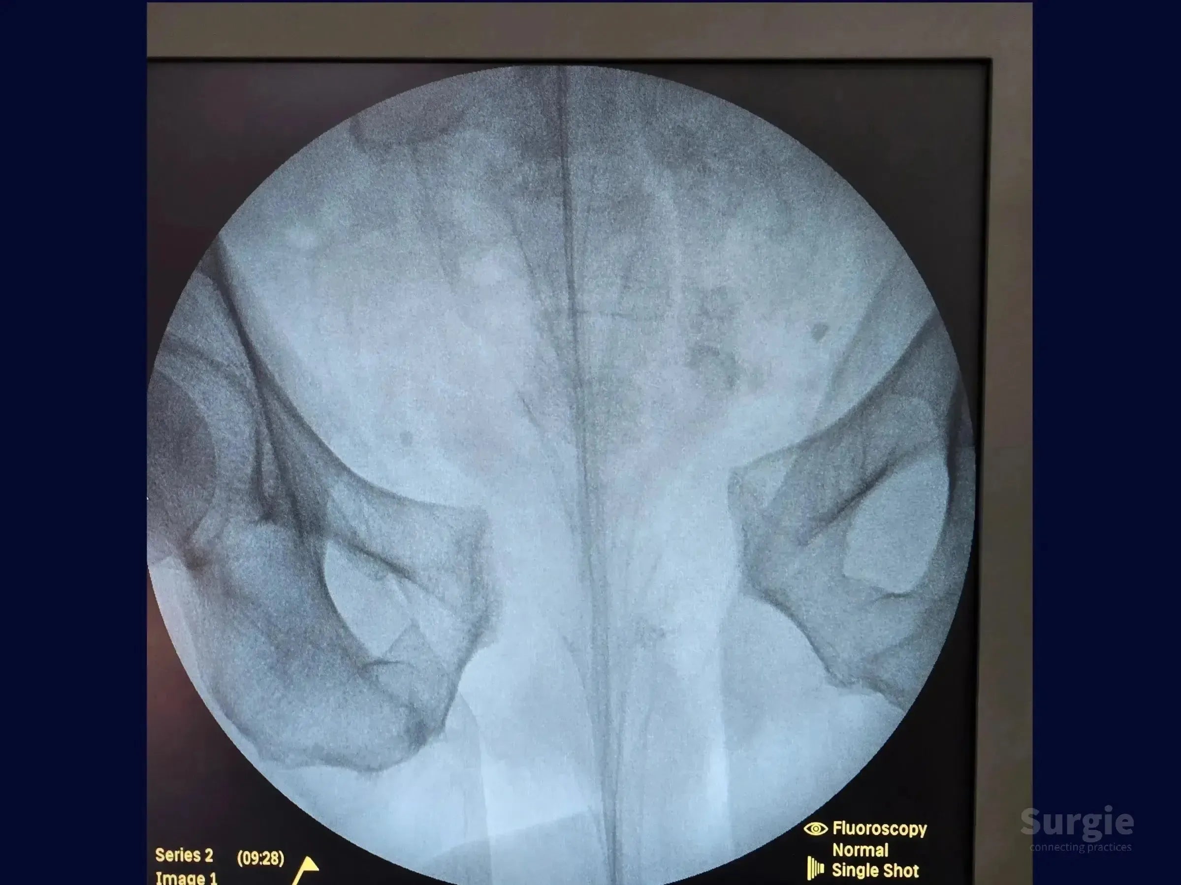 Fluoroscopic X-ray showing an open book pelvic ring injury with pubic symphysis dislocation on a medical monitor.