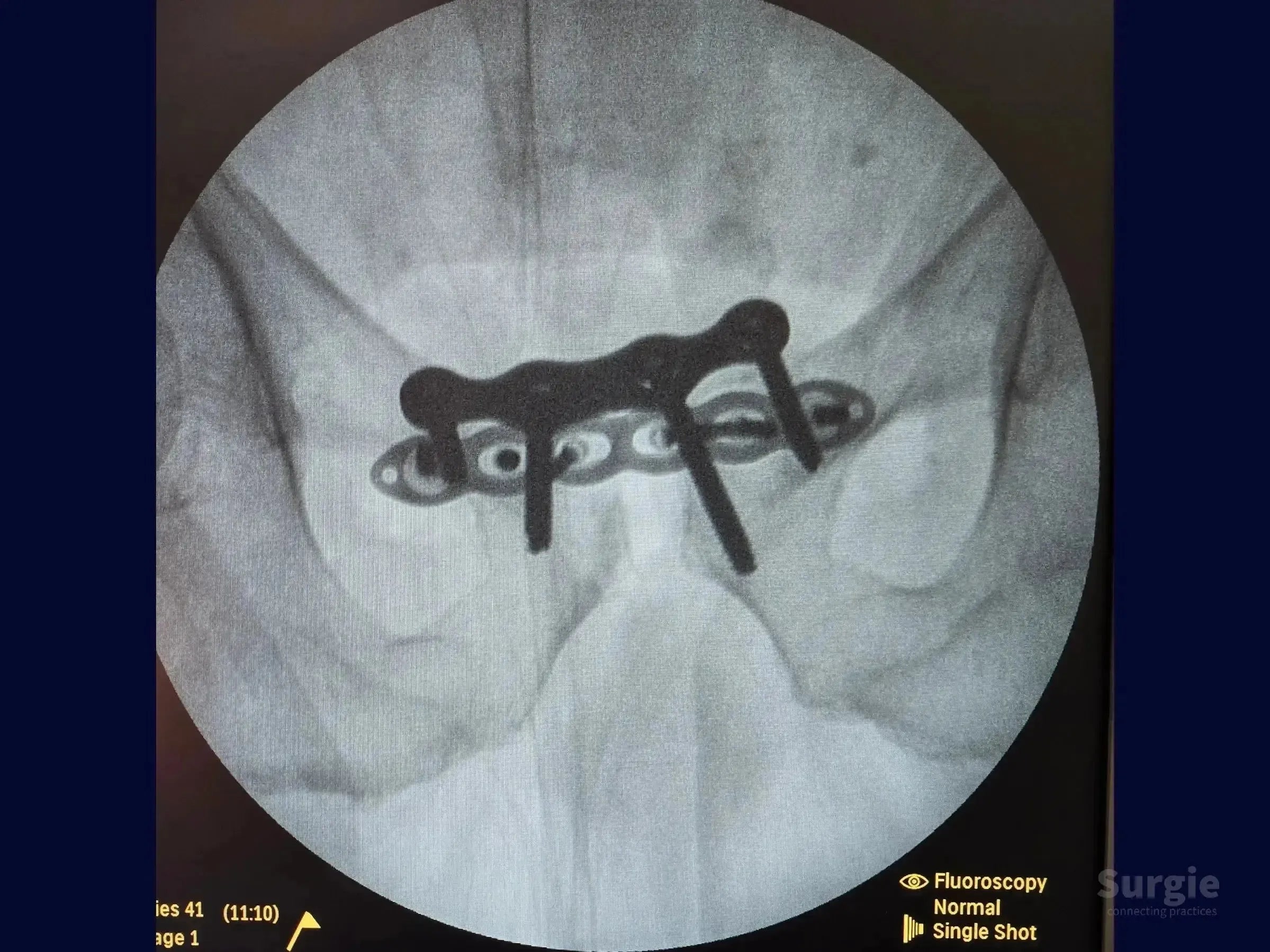 Fluoroscopic X-ray showing a metal fixation plate and screws stabilizing a pubic symphysis dislocation.