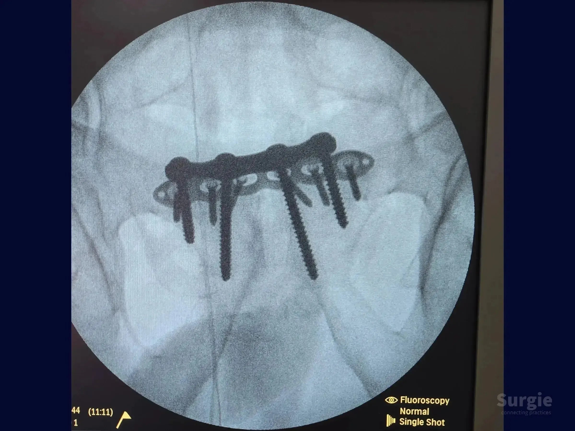 Fluoroscopic X-ray showing a metal plate and screws fixating a pubic symphysis dislocation for pelvic ring stability.