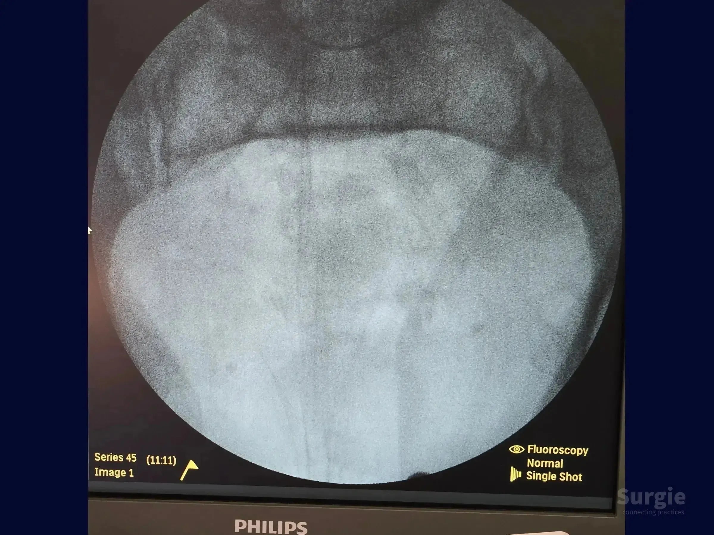 Fluoroscopic X-ray view of an open book pelvic ring injury showing pubic symphysis dislocation on a Philips monitor.