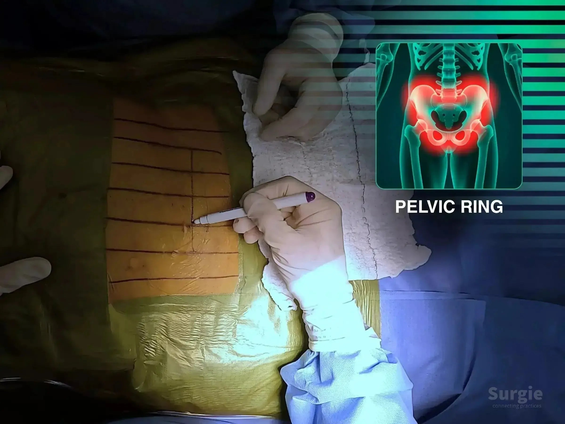 Surgeon marking a patient's abdomen for pelvic ring surgery with a digital overlay of a pubic symphysis dislocation.