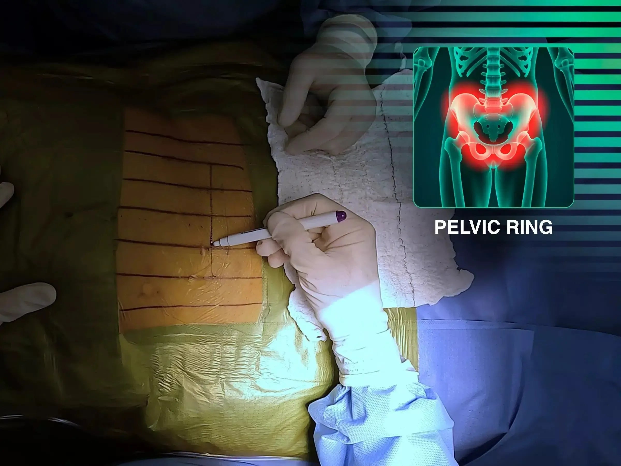 Open Book Pelvic Ring Injury (Pubic Symphysis Dislocation)