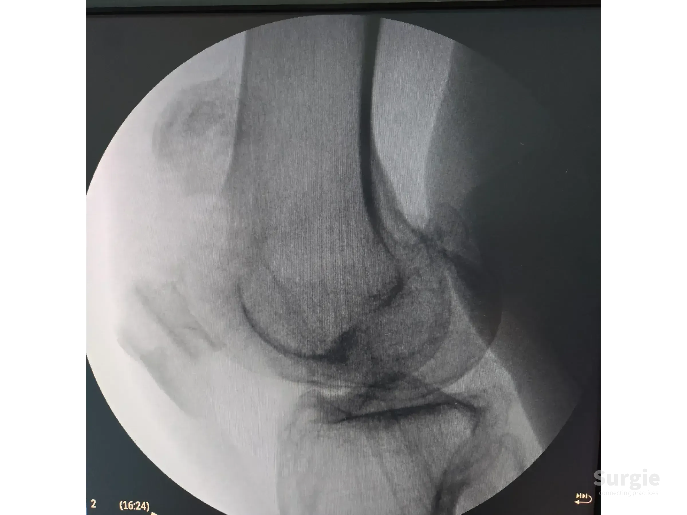 Lateral X-ray of a displaced patellar fracture showing bone alignment and surgical planning for osteosynthesis.