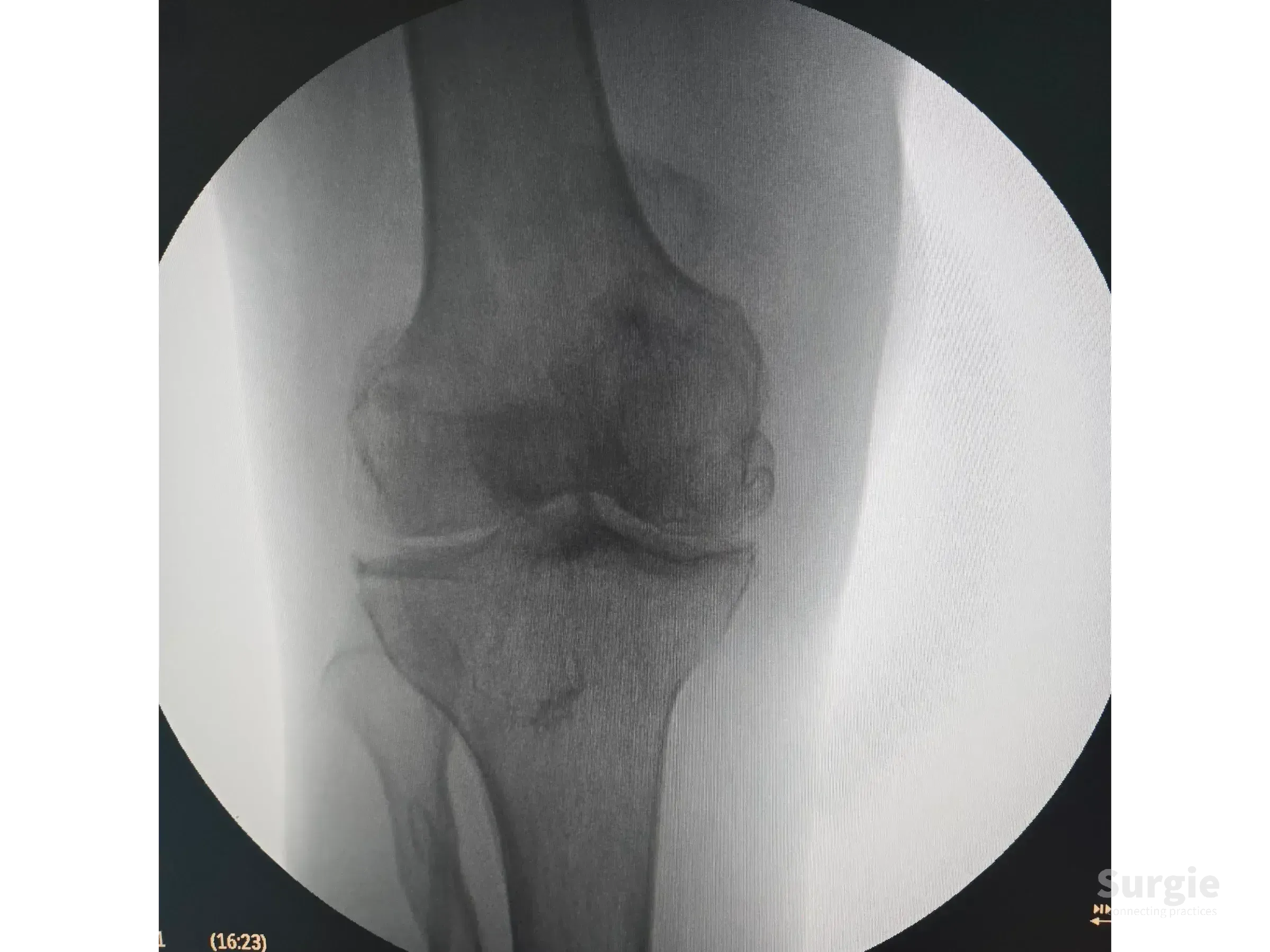 X-ray of a displaced patellar fracture showing the knee joint in a circular medical imaging view.