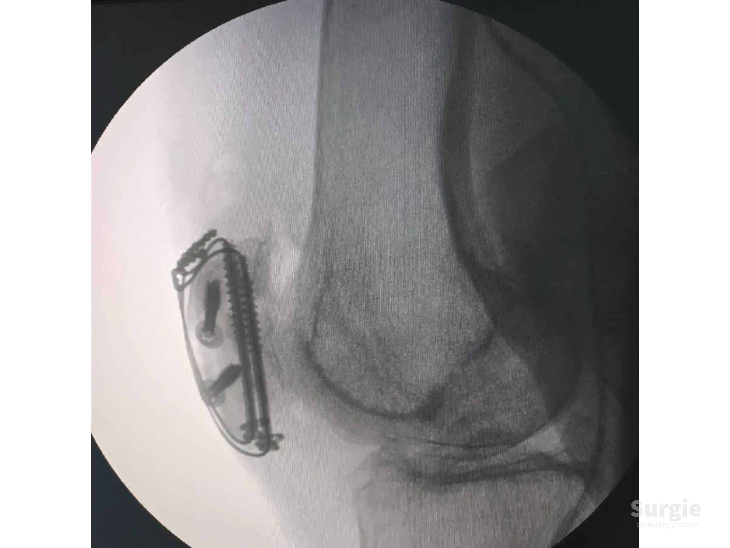 Lateral knee X-ray showing patellar fracture fixation with two cannulated screws and a tension band cerclage wire.