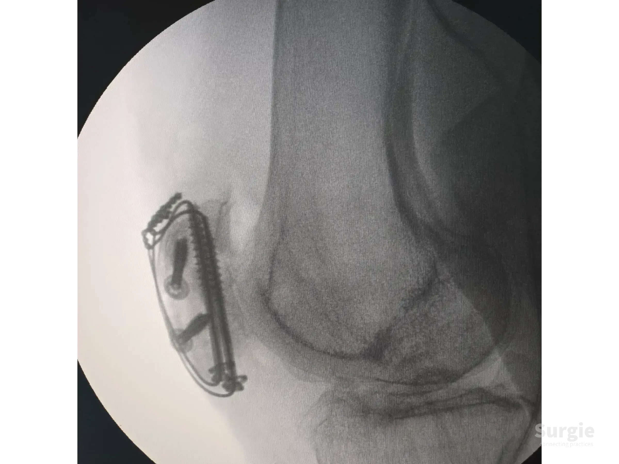 Lateral X-ray of a patellar fracture fixed with cannulated screws and a tension band cerclage wire construct.