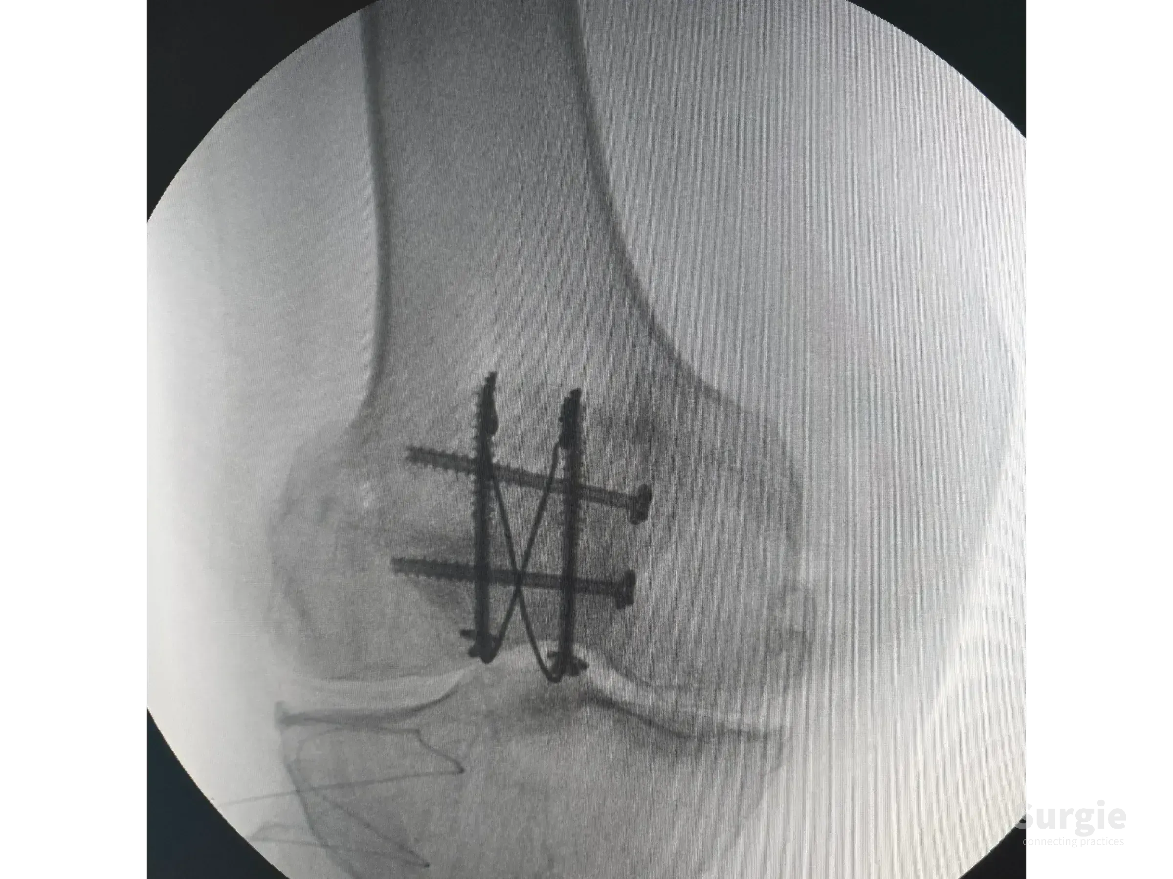 X-ray of a patellar fracture fixed with two parallel cannulated screws and a tension band cerclage wire configuration.