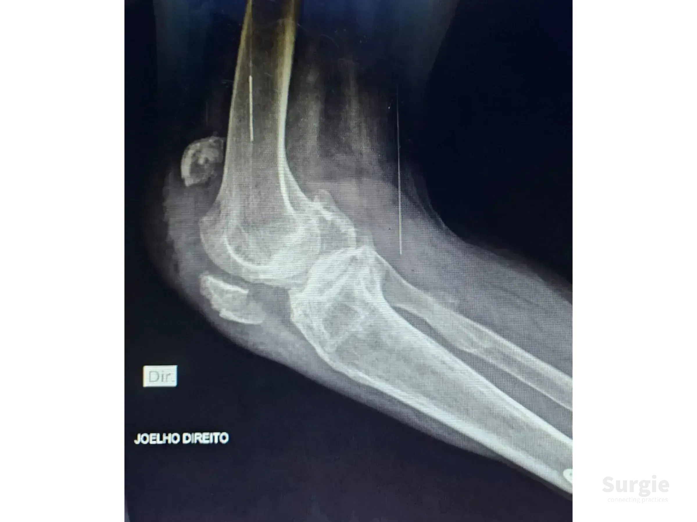 Lateral knee X-ray showing a displaced patellar fracture with bone fragments in a right knee joint.