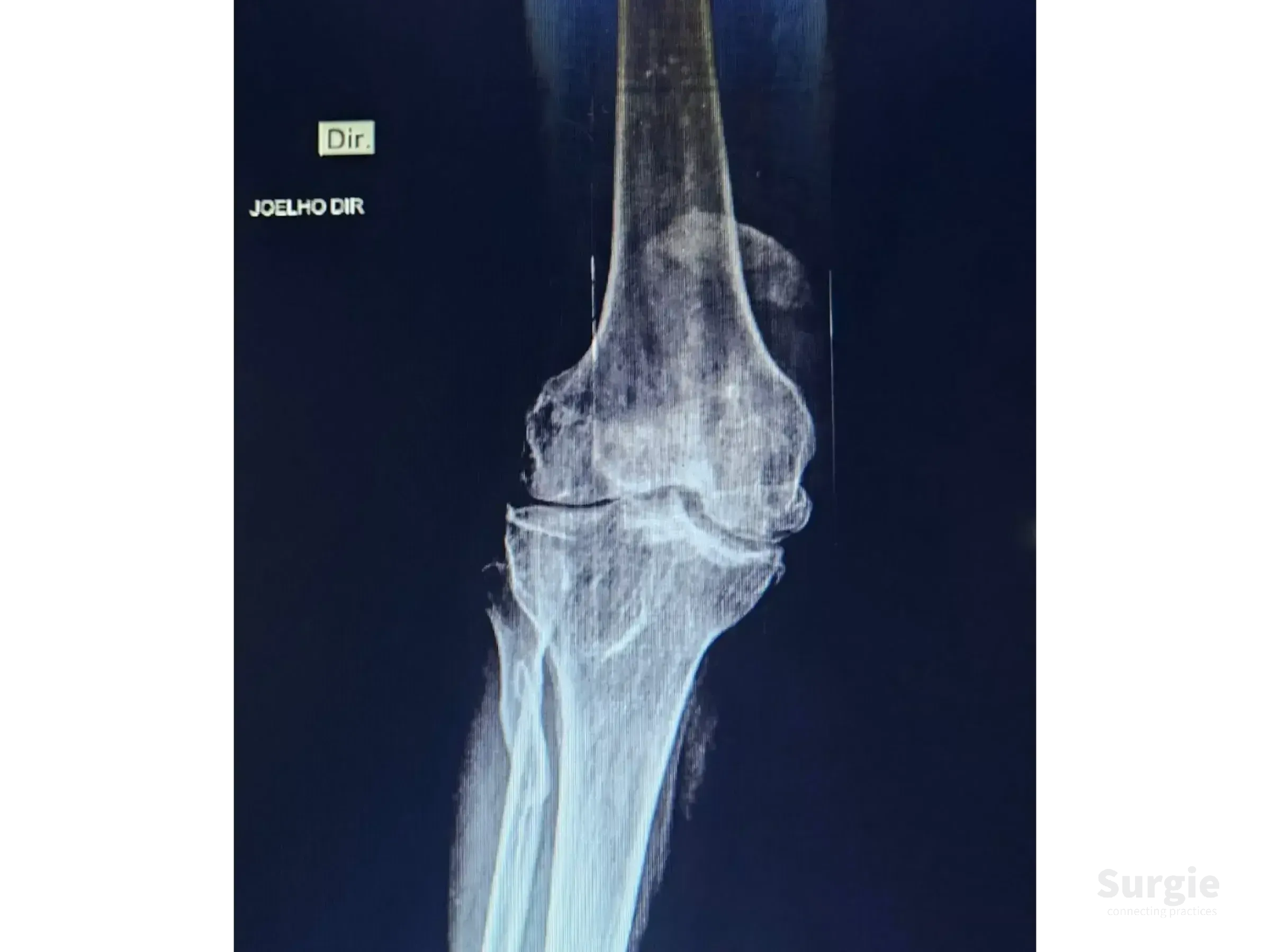 X-ray of a right knee showing a displaced patellar fracture with complex bone fragmentation and joint stiffness.