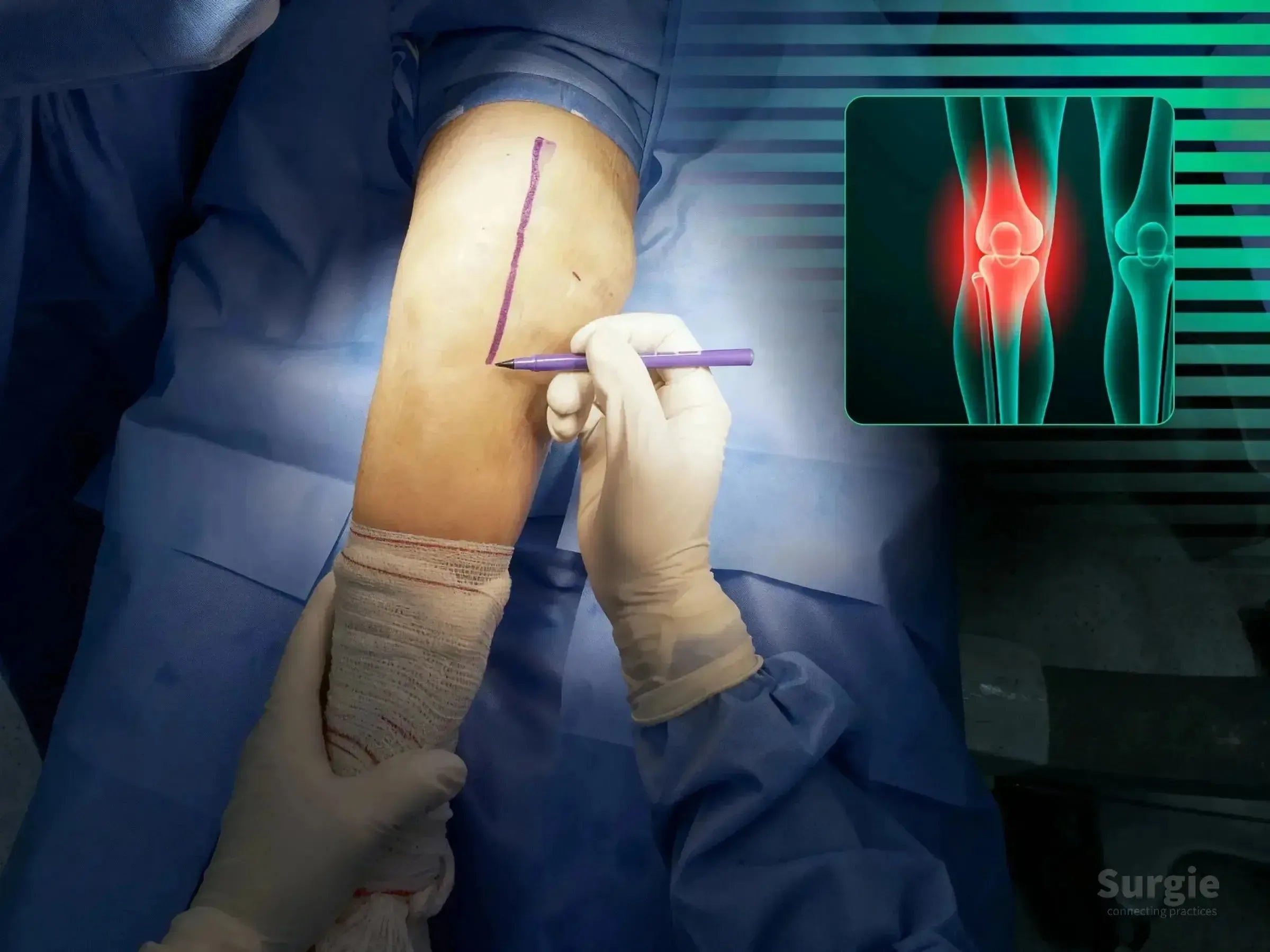 Surgeon marking a knee for patellar fracture surgery with an X-ray overlay showing a highlighted patella injury.